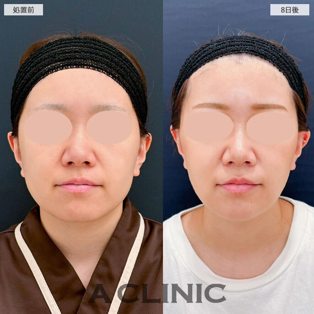 1day小顔脂肪吸引と小顔エラボトックスを合わせることでより小顔に！こちら処置前から1ヶ月半後の症例です(20代女性)