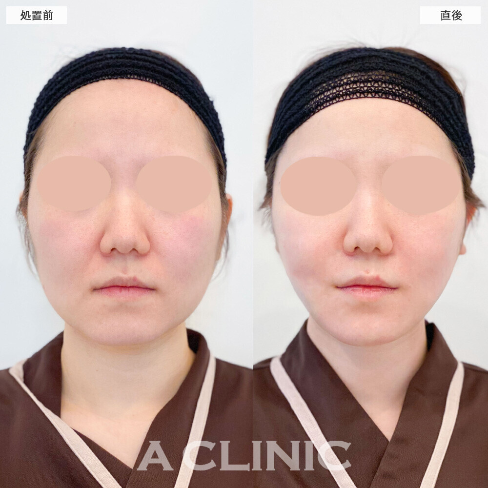 1day小顔脂肪吸引と小顔エラボトックスで卵型からVフェイスに！こちら処置前から3週間後の症例です(30代女性)