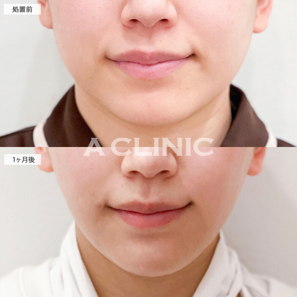 1day小顔脂肪吸引と複合手術で別人級の輪郭に！こちら処置前から1ヶ月後の症例です(20代女性)