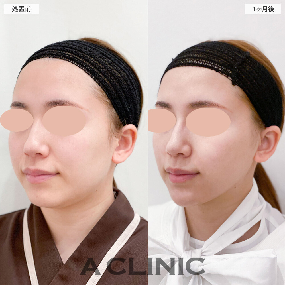 1day小顔脂肪吸引と複合手術で別人級の輪郭に！こちら処置前から1ヶ月後の症例です(20代女性)