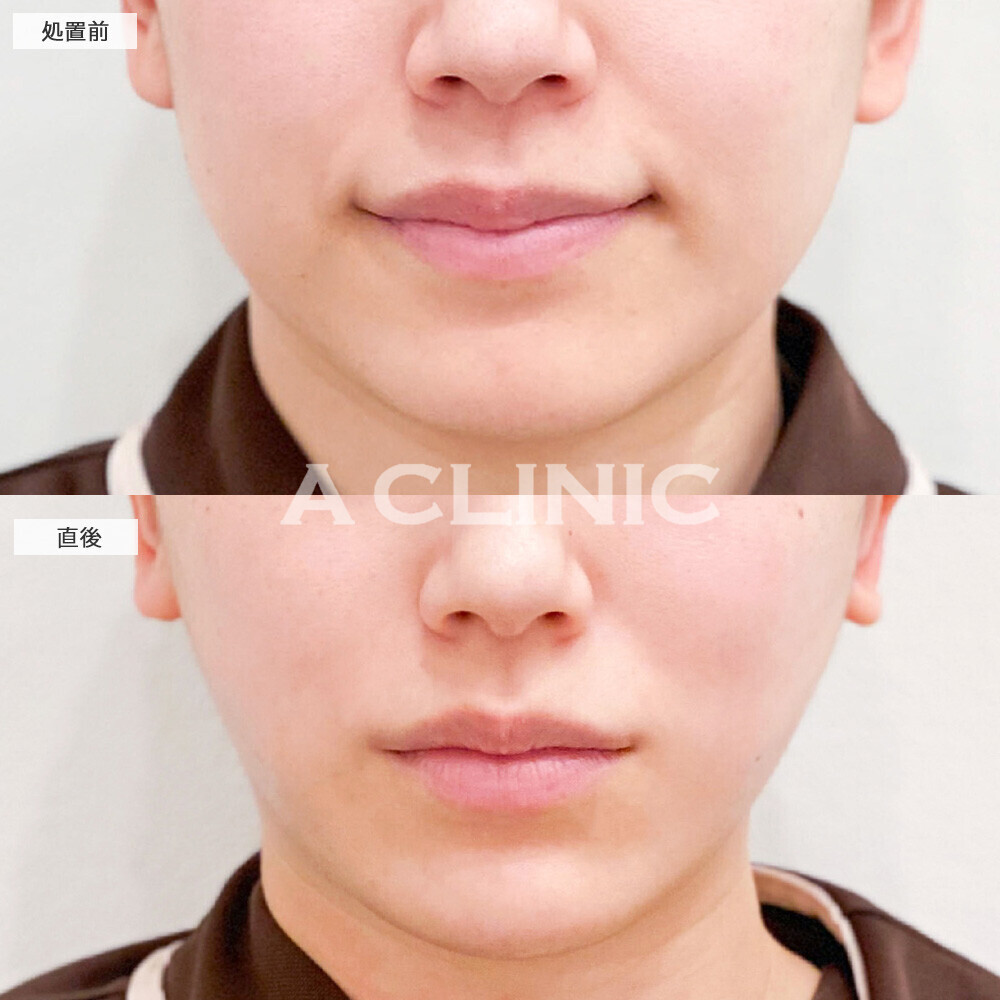 1day小顔脂肪吸引と複合手術で別人級の輪郭に！こちら処置前から1ヶ月後の症例です(20代女性)