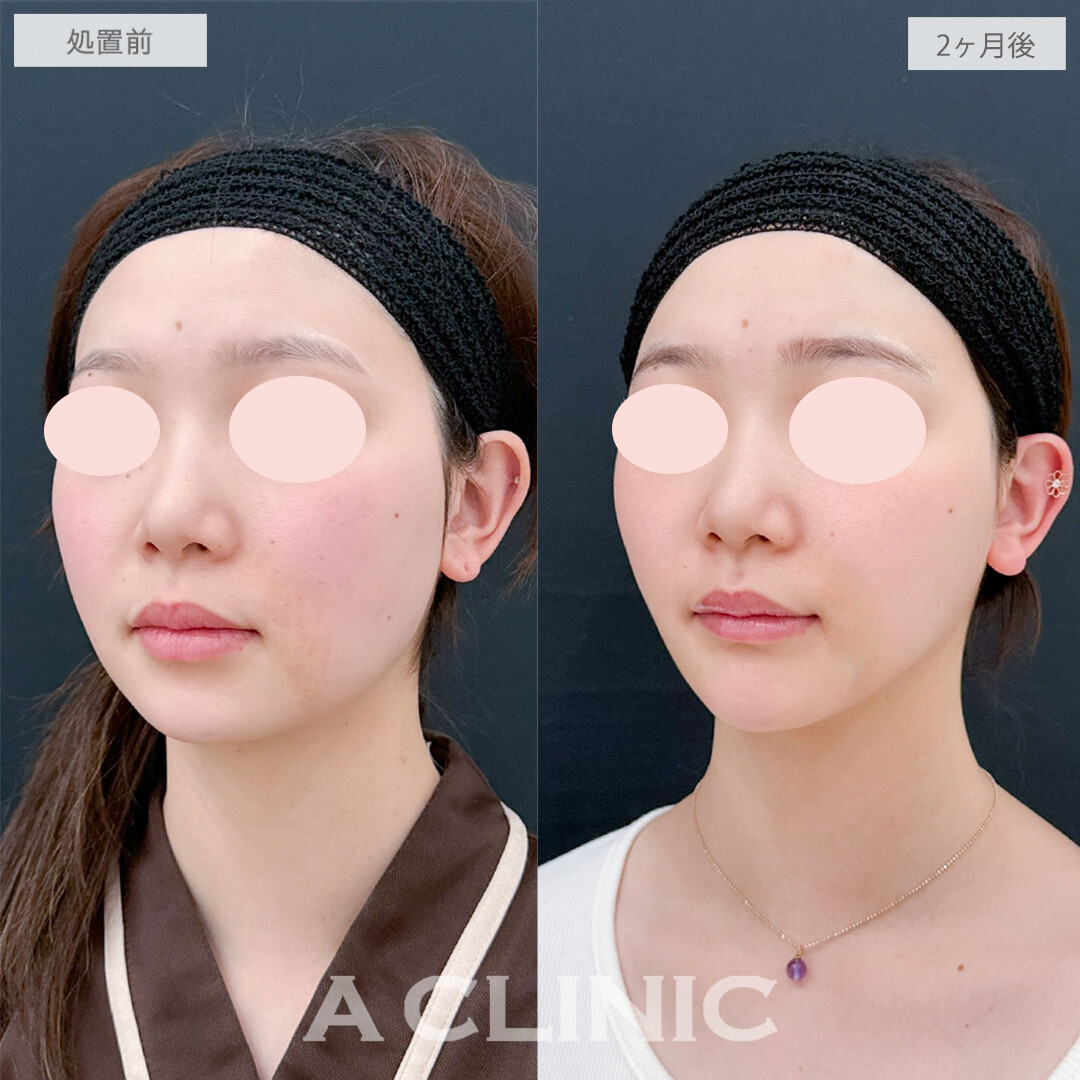 1day小顔脂肪吸引とバッカルファット除去術でお顔のボリュームが改善！こちら処置前と2ヶ月後の症例です(30代女性)