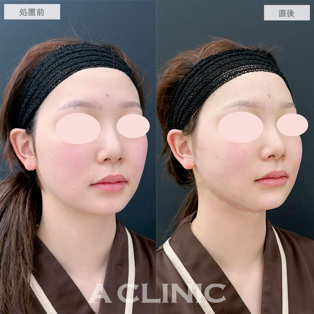 施術直後でもここまで腫れが少なくダウンタイム最小限！1day小顔脂肪吸引とバッカルファット除去術の処置前と処置直後の症例です(20代女性)