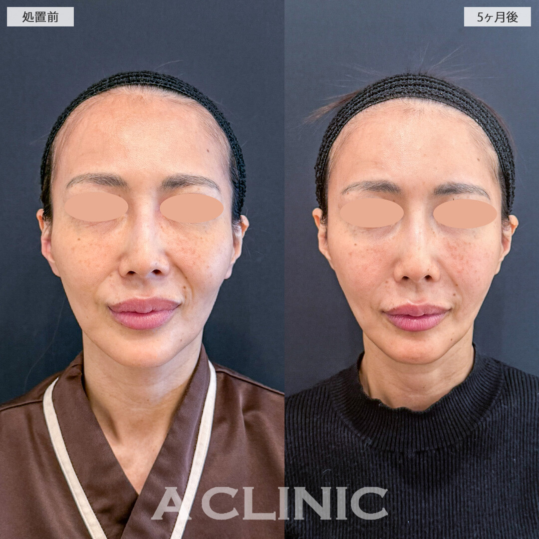 【直後の傷跡あり】A式美肌たるみ切開でたるみ改善した結果、5ヶ月経ってもたるまない輪郭を維持しています！こちら処置前と5ヶ月後の症例です(40代女性)