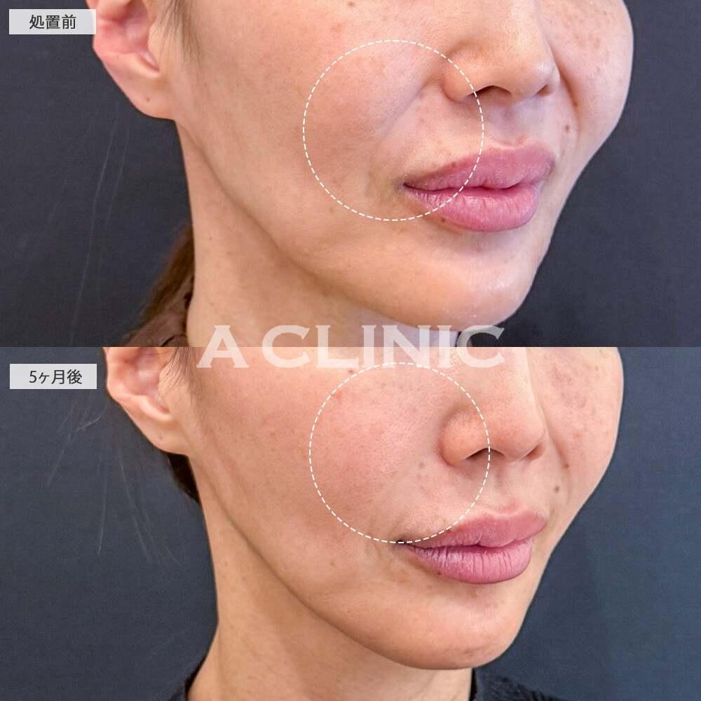 【直後の傷跡あり】A式美肌たるみ切開でたるみ改善した結果、5ヶ月経ってもたるまない輪郭を維持しています！こちら処置前と5ヶ月後の症例です(40代女性)