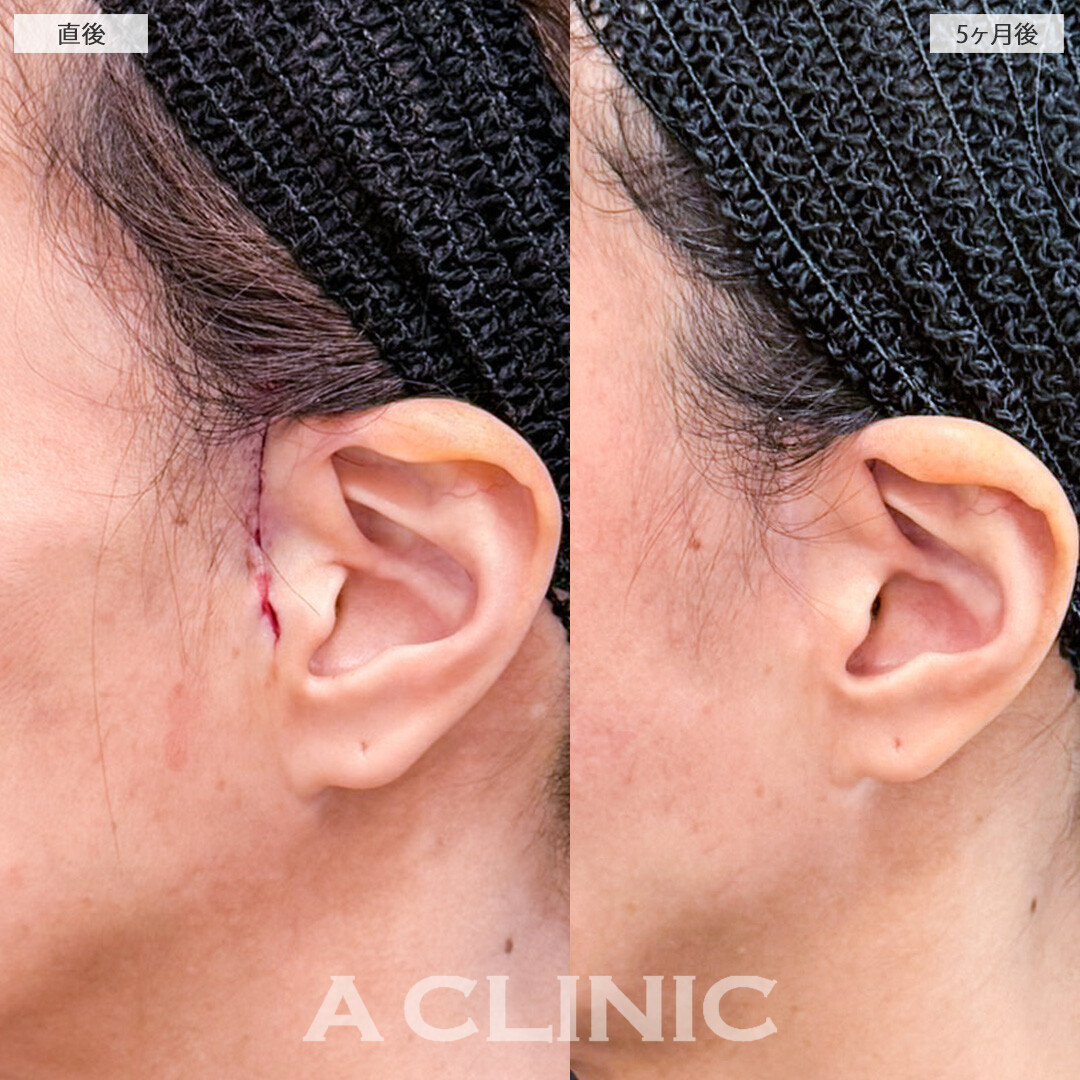 【直後の傷跡あり】A式美肌たるみ切開でたるみ改善した結果、5ヶ月経ってもたるまない輪郭を維持しています！こちら処置前と5ヶ月後の症例です(40代女性)