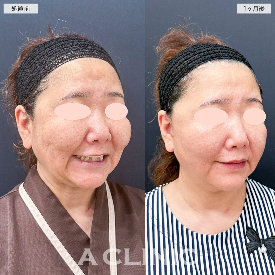 【直後の傷跡あり】A式美肌たるみ切開と1day小顔脂肪吸引で深かったマリオネットラインが急激に薄くなりました！こちら処置前と1ヶ月後の症例です(50代女性)