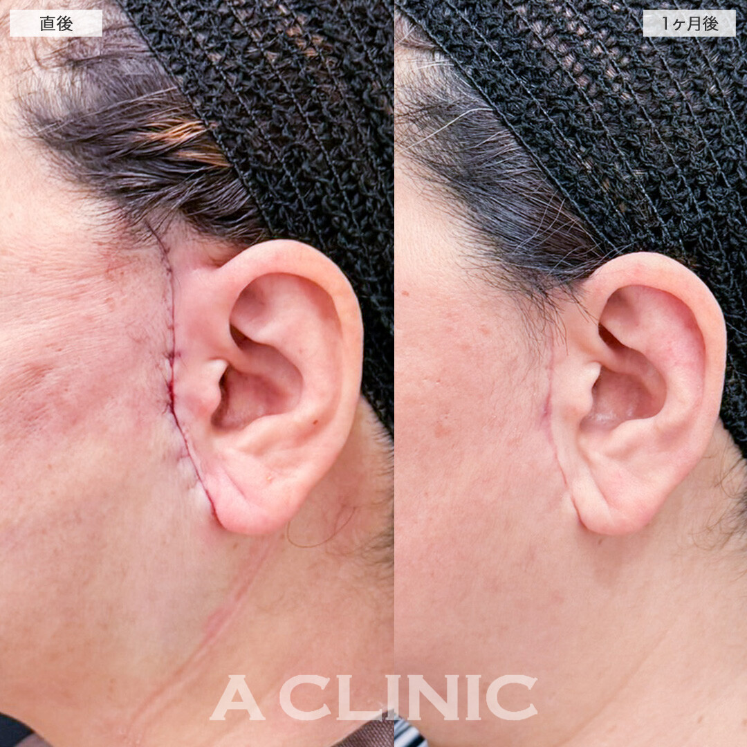 【直後の傷跡あり】A式美肌たるみ切開と1day小顔脂肪吸引で深かったマリオネットラインが急激に薄くなりました！こちら処置前と1ヶ月後の症例です(50代女性)