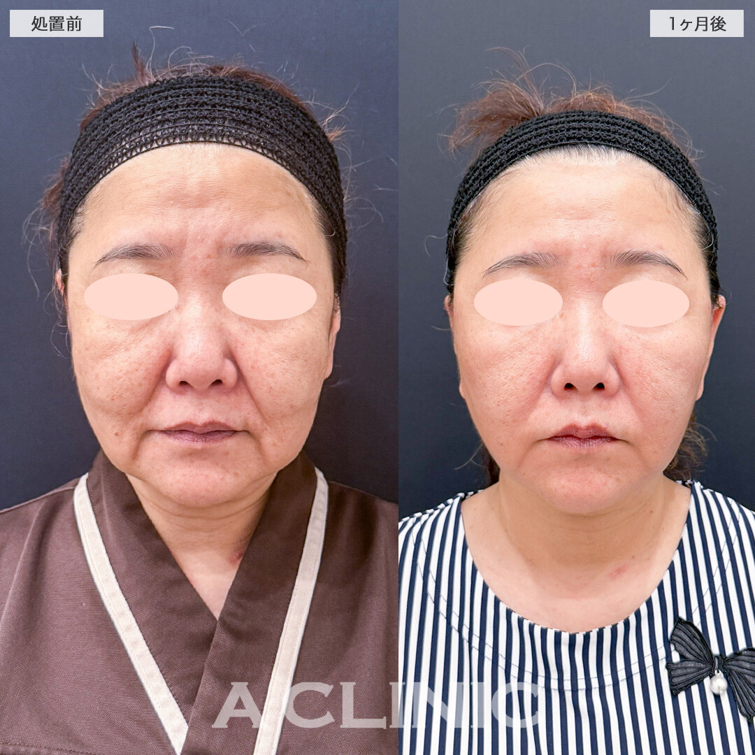【直後の傷跡あり】A式美肌たるみ切開と1day小顔脂肪吸引で深かったマリオネットラインが急激に薄くなりました！こちら処置前と1ヶ月後の症例です(50代女性)