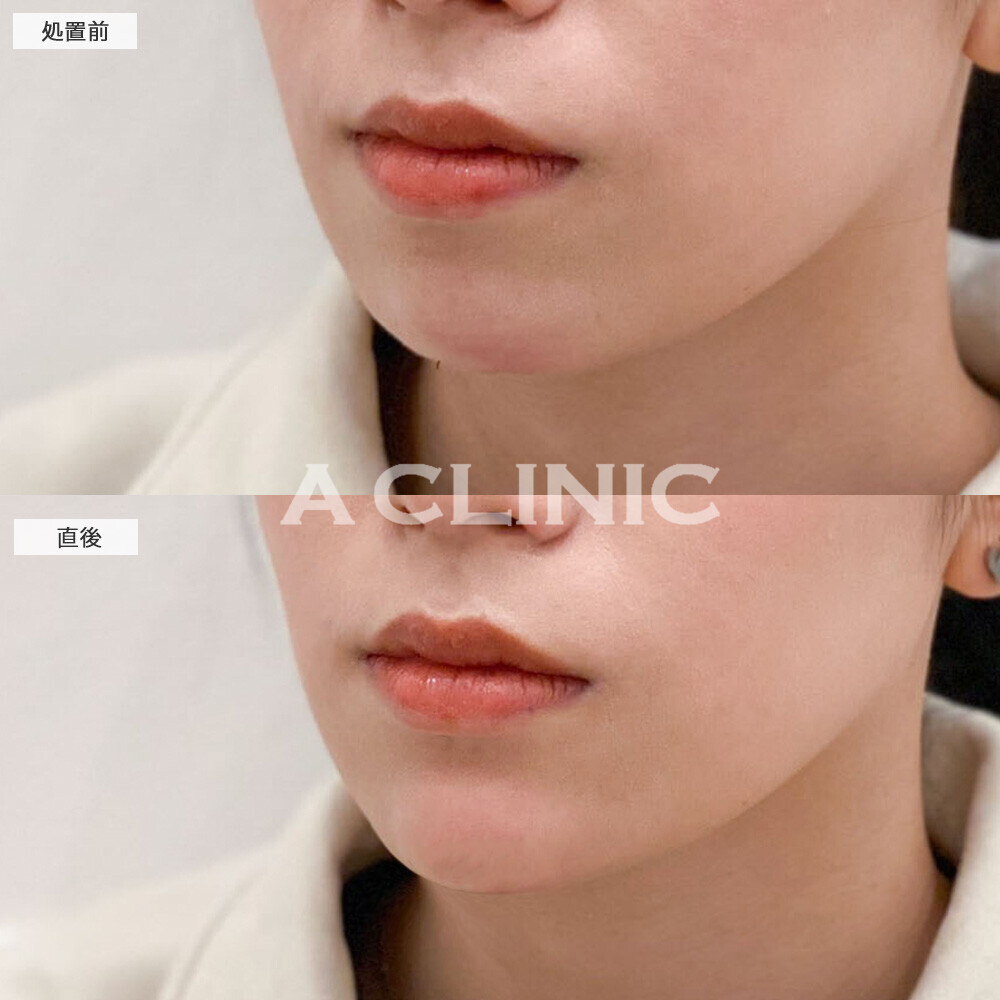 あごへのヒアルロン酸注入でシャープな印象の輪郭に！こちら処置前と直後の症例です(20代女性)