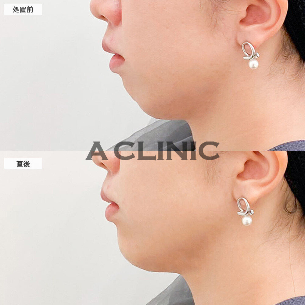 あごへのヒアルロン酸注入で横顔の凹凸感が綺麗に整いました！こちら処置前と直後の症例です(20代女性)