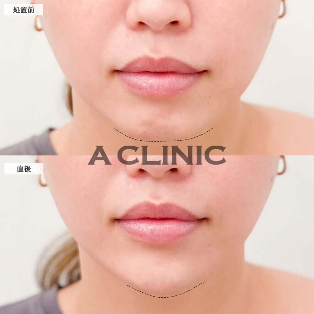 あごへのヒアルロン酸注入で丸みのあったアゴ先からVフェイスに！こちら処置前と直後の症例です(20代女性)