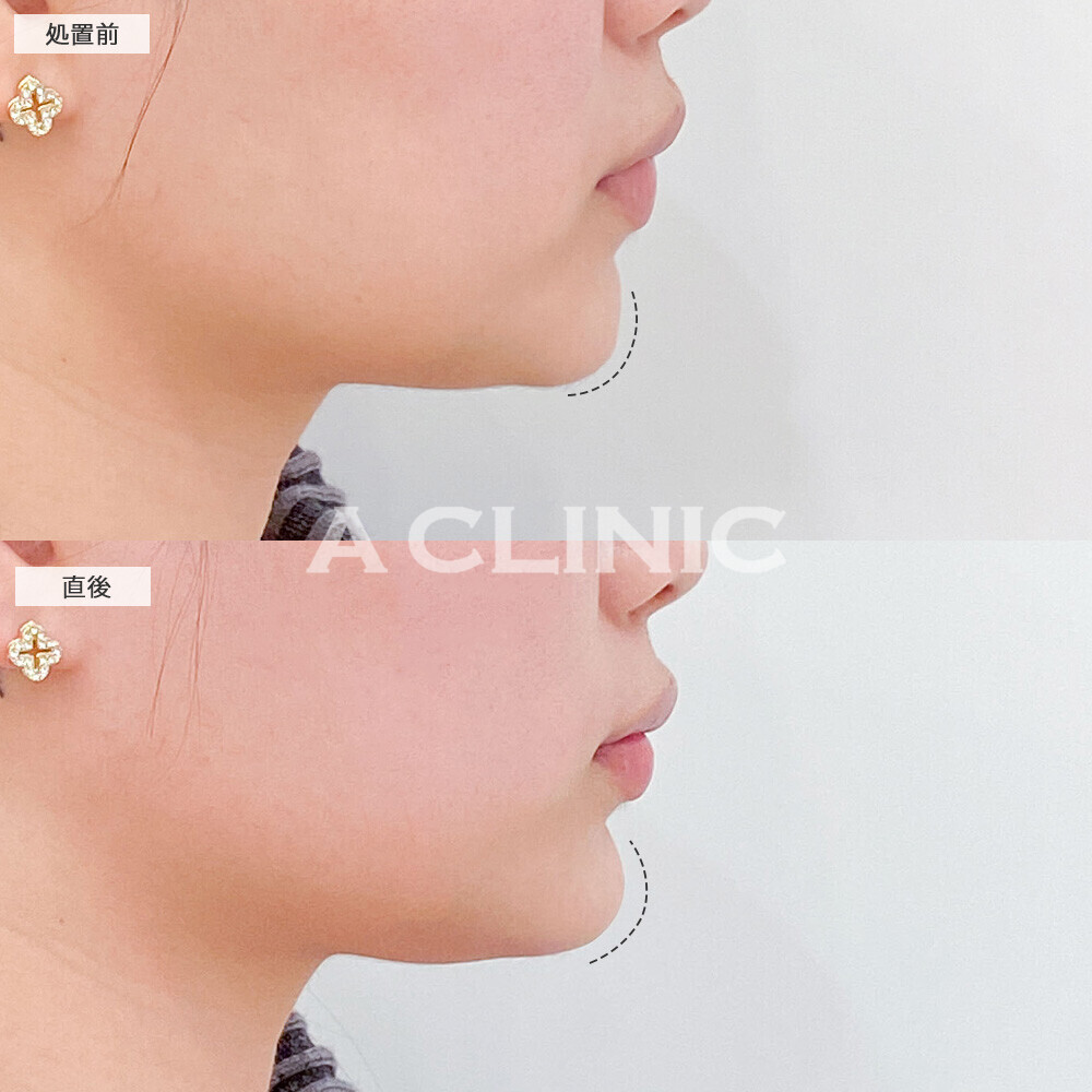 あごへのヒアルロン酸注入でEラインが整いました！こちら処置前と直後の症例です(20代女性)
