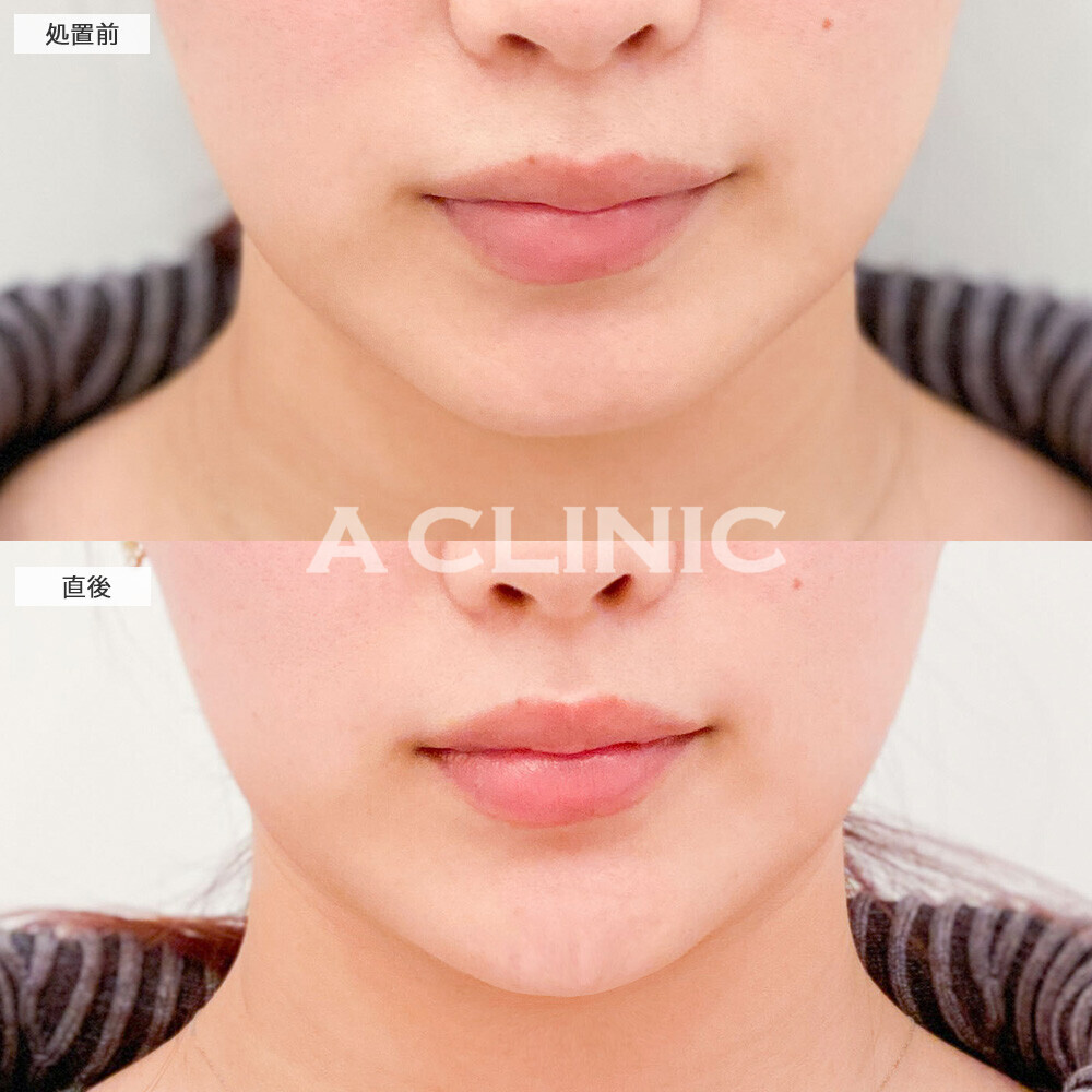 あごへのヒアルロン酸注入でEラインが整いました！こちら処置前と直後の症例です(20代女性)