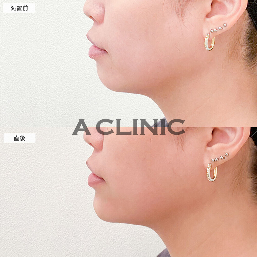 あごへのヒアルロン酸注入で丸みのあったアゴ先からVフェイスに！こちら処置前と直後の症例です(20代女性)