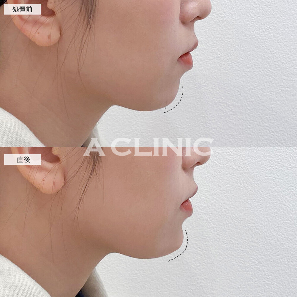 あごへのヒアルロン酸注入でシャープな印象の輪郭に！こちら処置前と直後の症例です(20代女性)