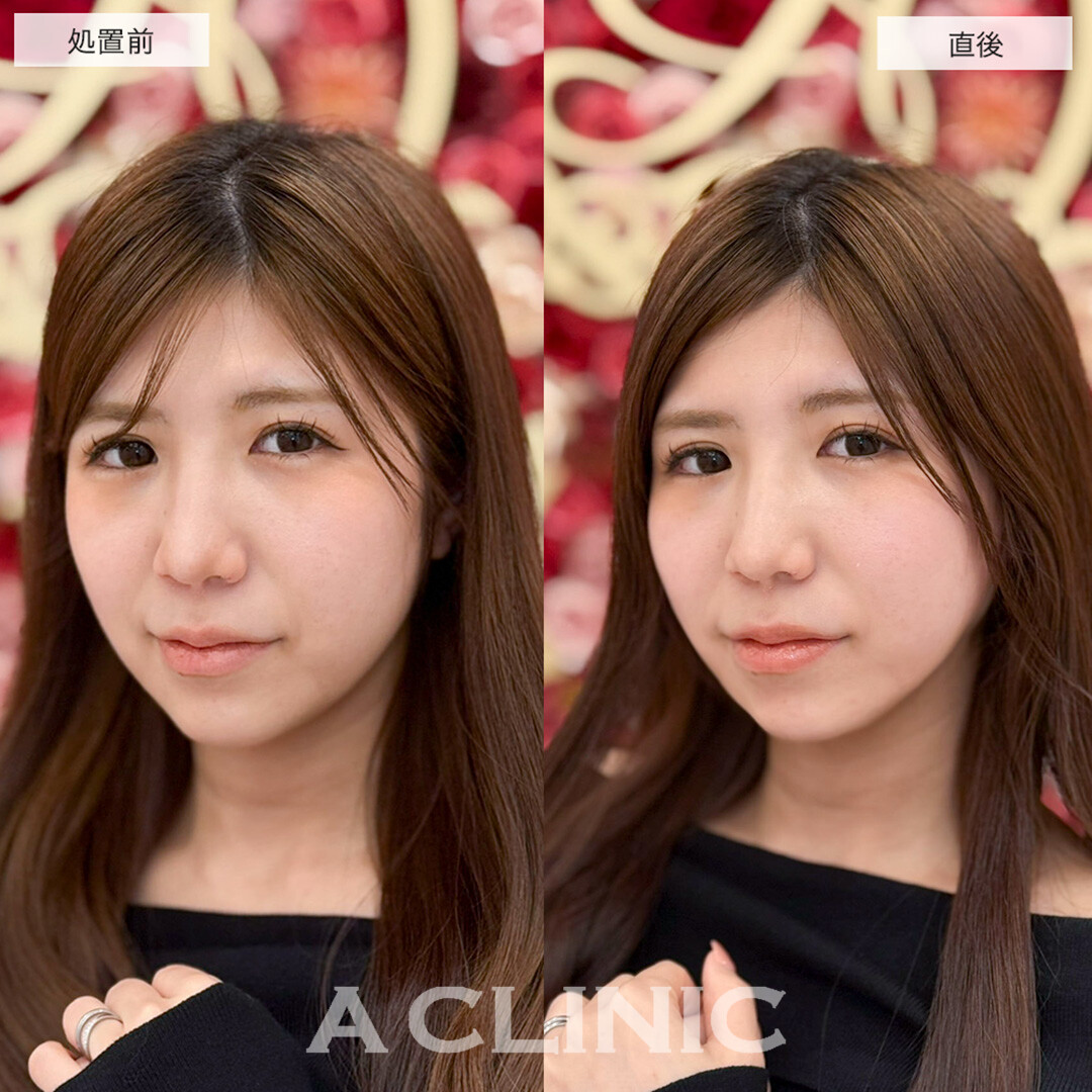 Aスレッドで即日理想の逆三角形の輪郭に!こちら処置前と直後の症例です(20代女性)