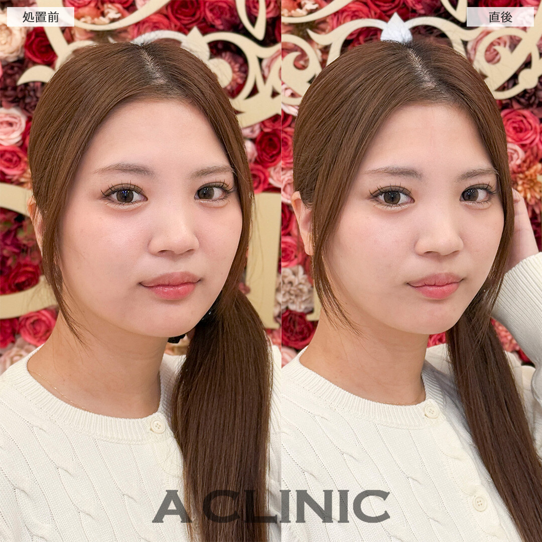 Aスレッドで即日リフトアップが叶う！処置前と直後の症例です(20代女性)