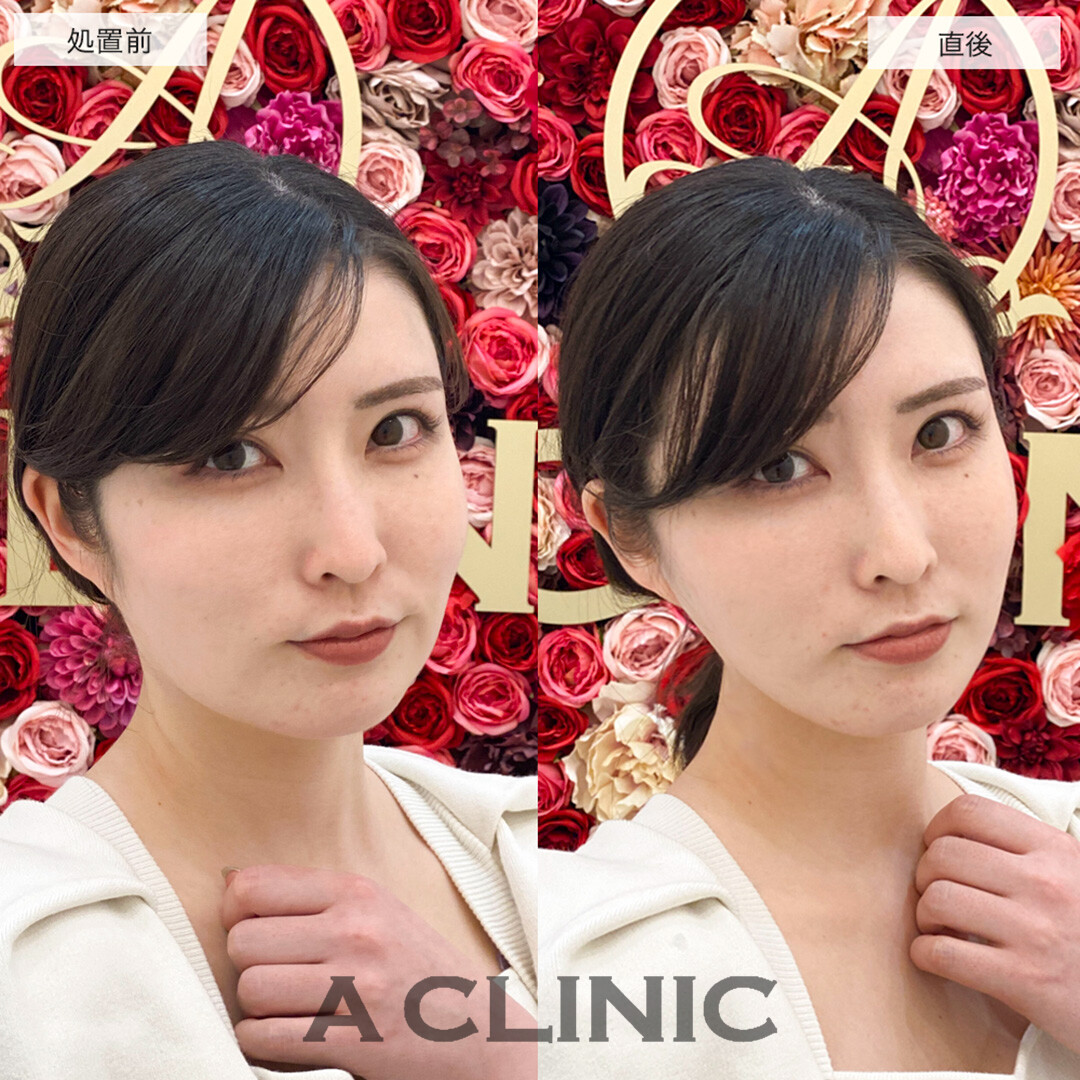 Aスレッドで輪郭のもたつきが引き上がり中顔面短縮!こちら処置前と直後の症例です(20代女性)