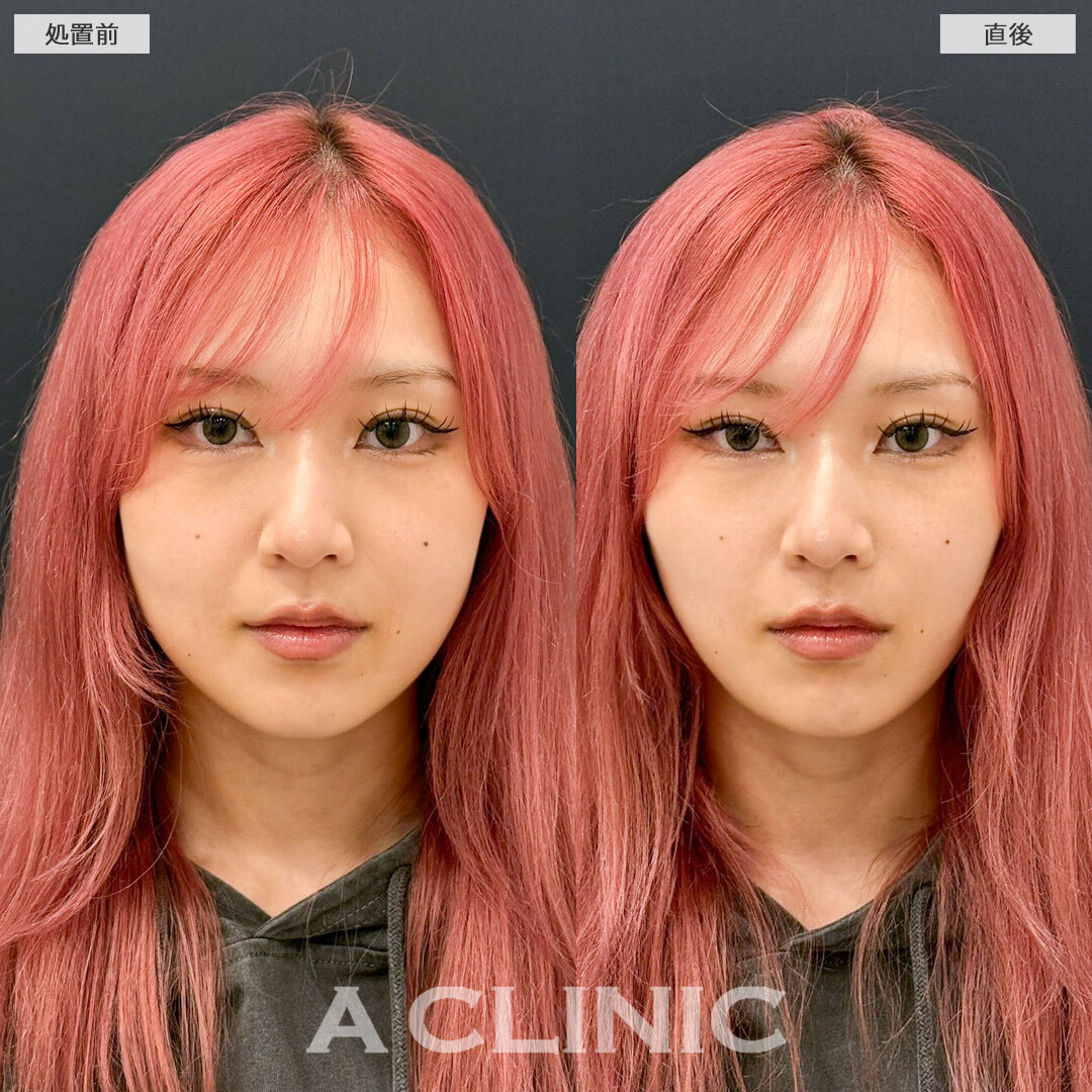 Aスレッドで気になっていたほうれい線も薄くなりました！こちら処置前と直後の症例です(20代女性)