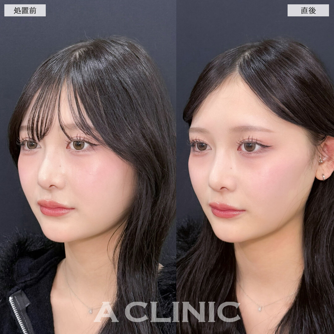 Aスレッドで理想のVフェイスを叶えられます！こちら処置前と直後の症例です(10代女性)