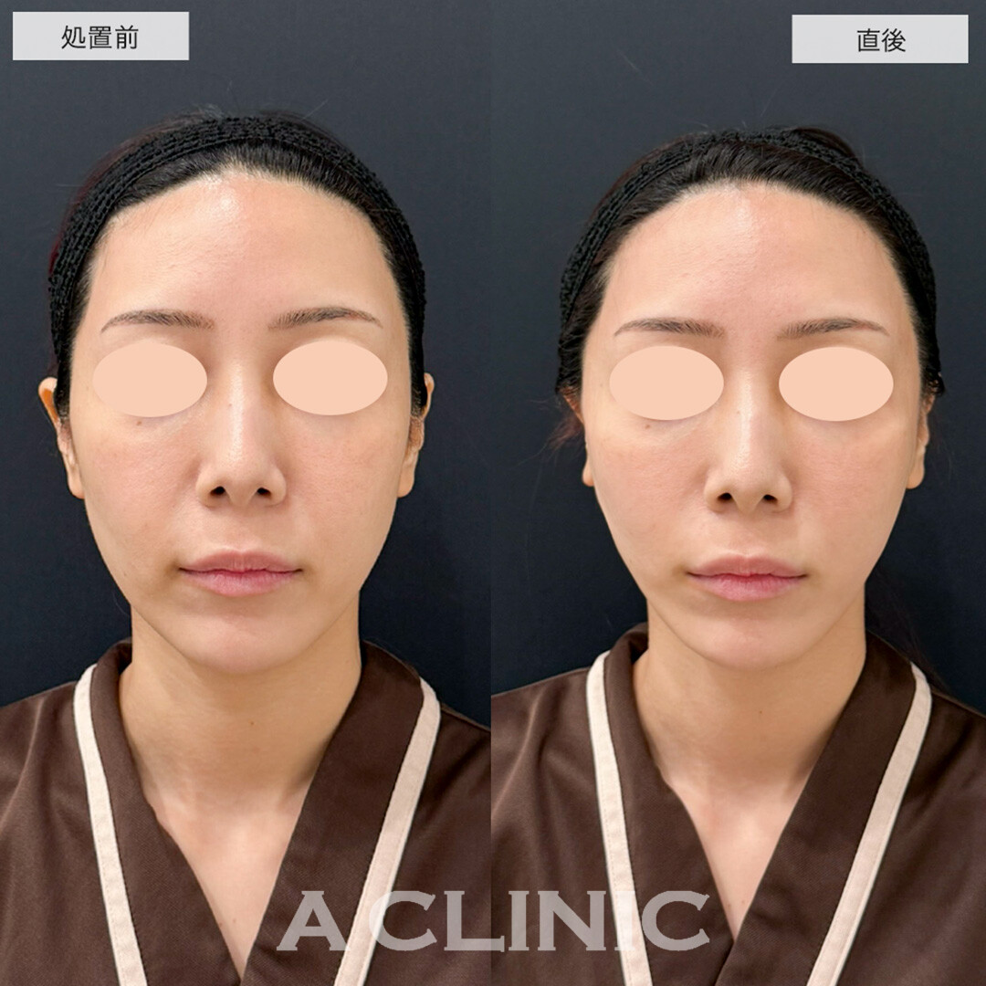 Aスレッドで口横のポニョが改善しスッキリした小顔に!こちら処置前と直後の症例です(30代女性)