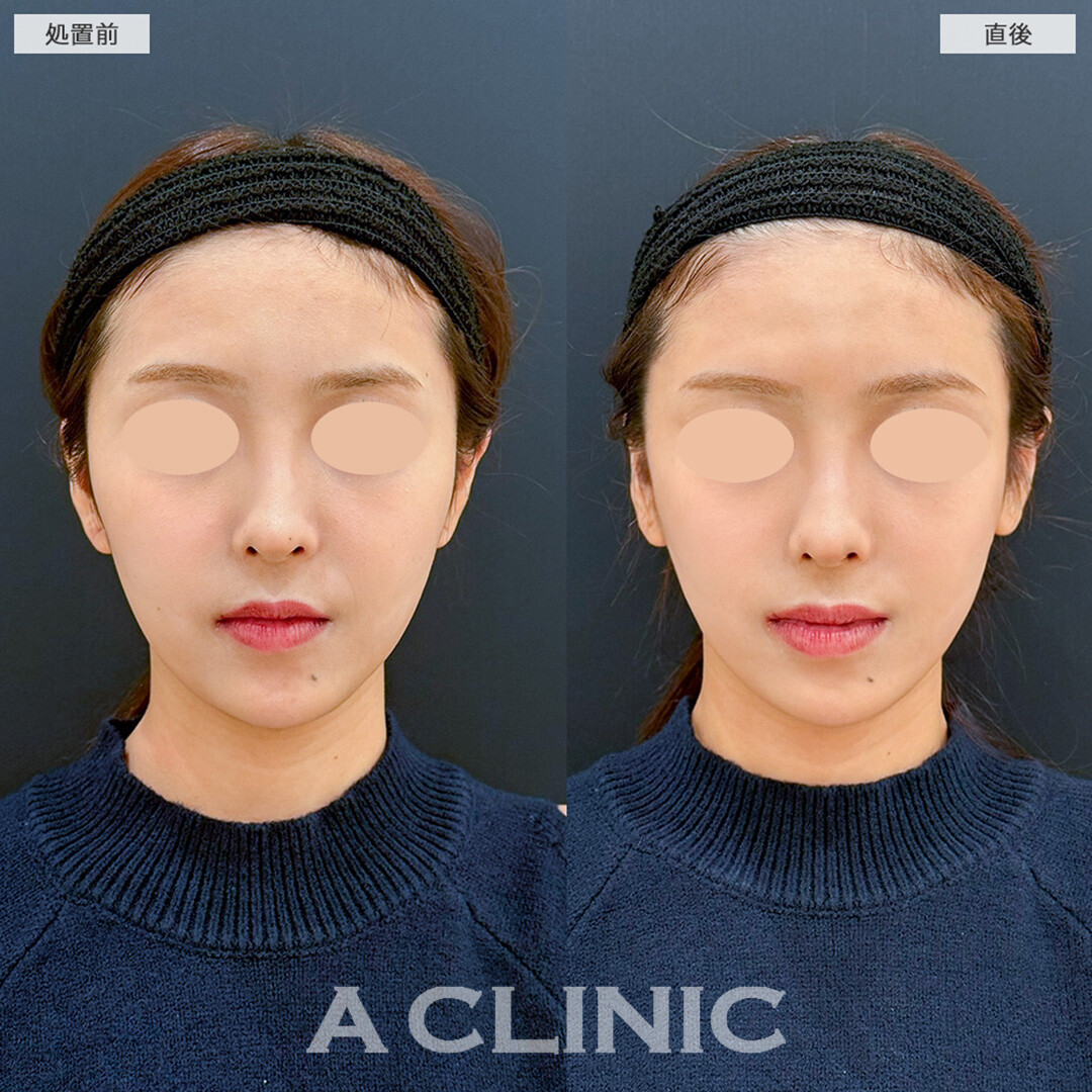 Aスレッドでさらに輪郭を綺麗に整える！こちら処置前と直後の症例です(20代女性)