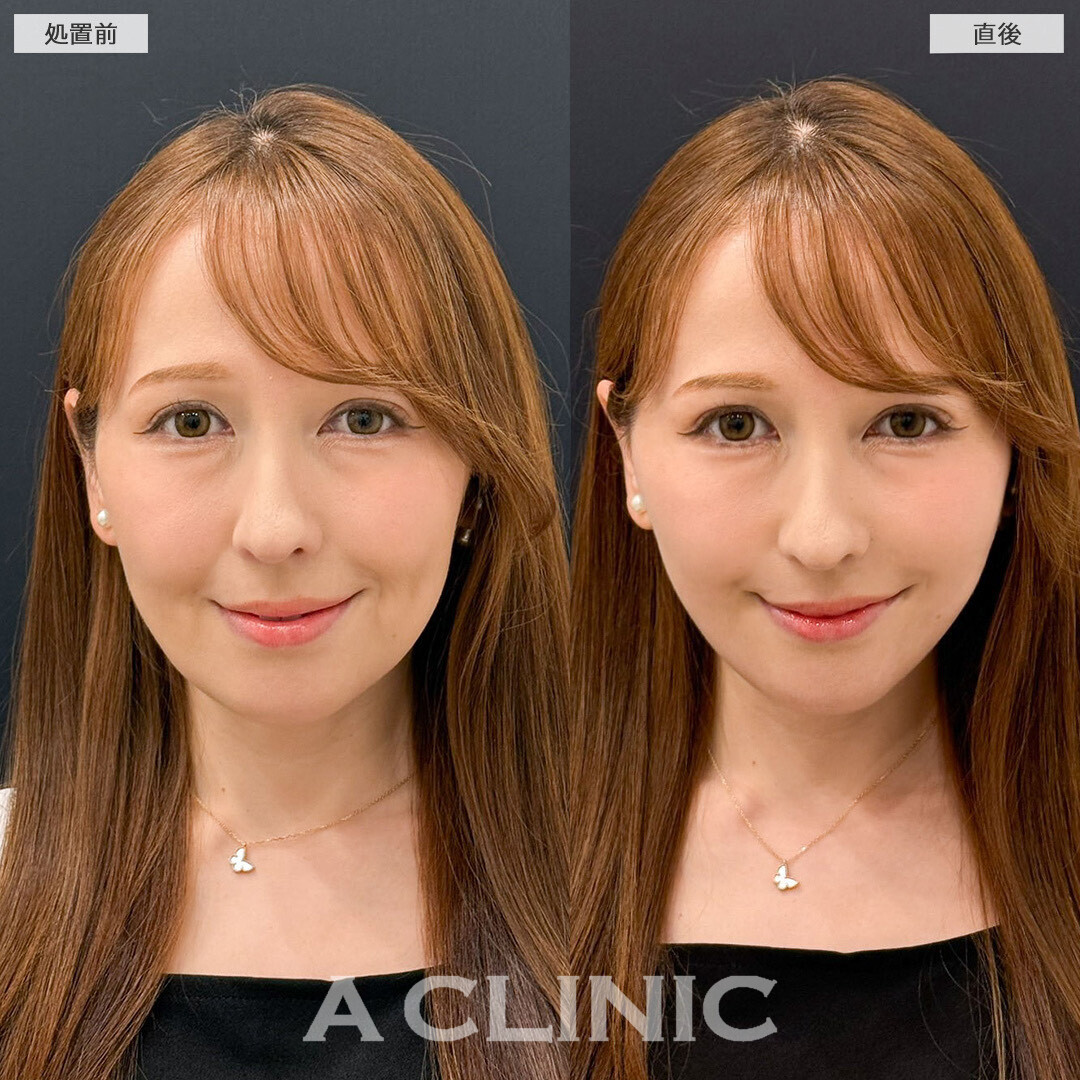 Aスレッドでお悩みだったほうれい線改善しました！こちら処置前と直後の症例です(40代女性)
