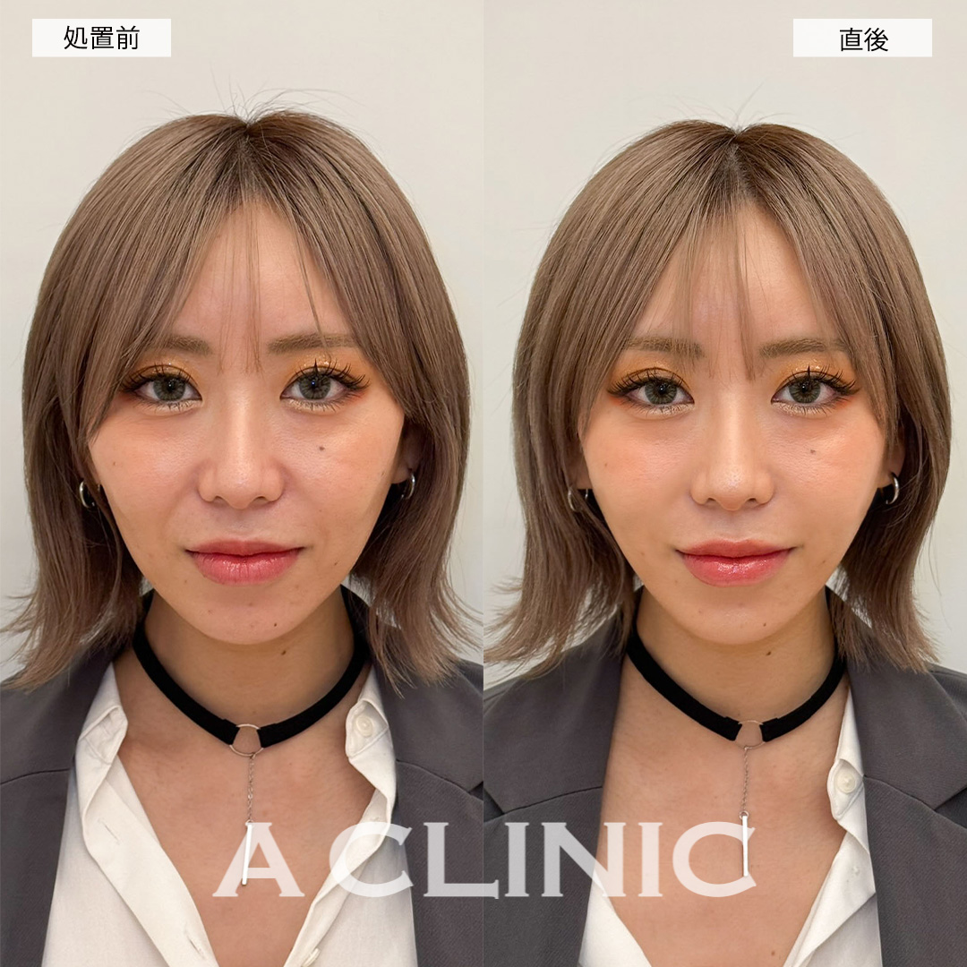 Aスレッドで年齢と共に気になってきたほうれい線が改善されました！こちら処置前と直後の症例です(30代女性)