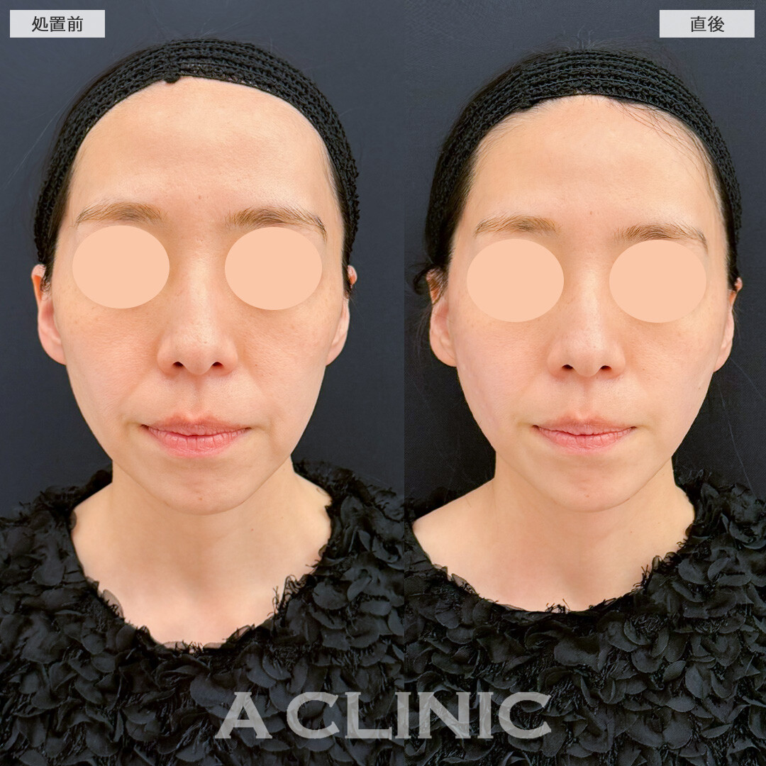 Aスレッドと頬へのヒアルロン酸注入で左右差無くなりほうれい線も薄くなりました！処置前と直後の症例です(30代女性)