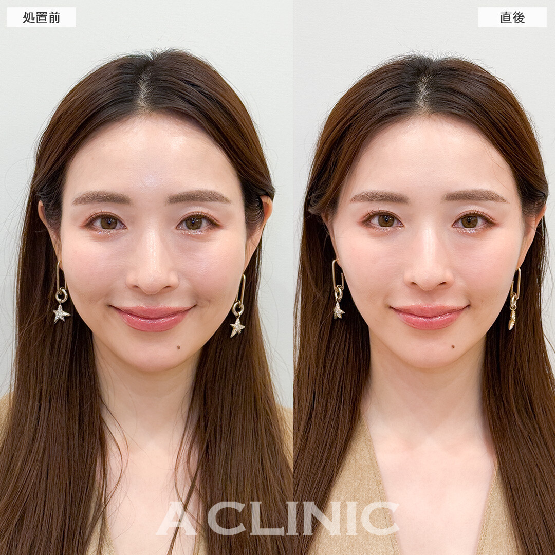 Aスレッドと頬へのヒアルロン酸注入で可愛い系から美人系に変身！処置前と直後の症例です(30代女性)