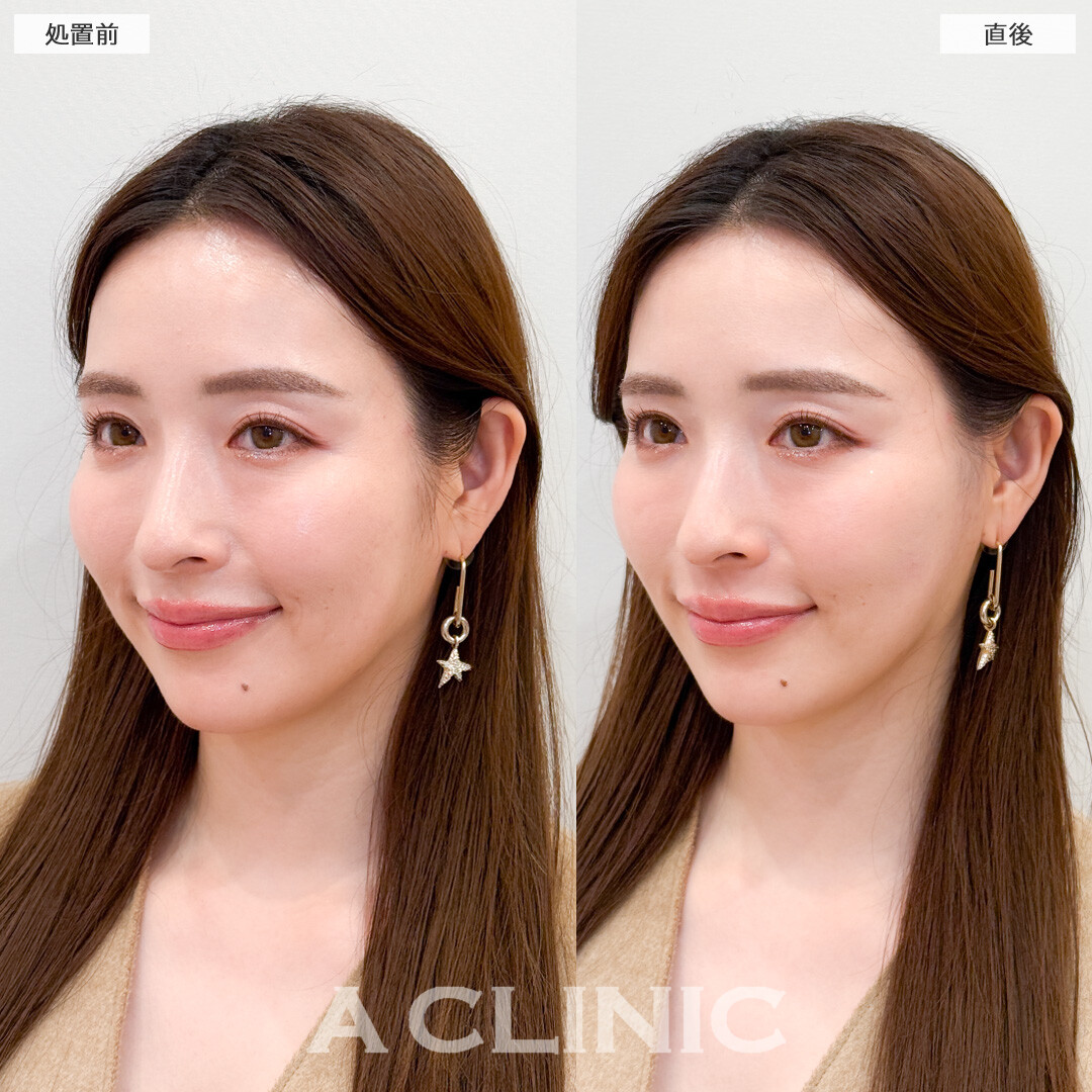 Aスレッドと頬へのヒアルロン酸注入で可愛い系から美人系に変身！処置前と直後の症例です(30代女性)