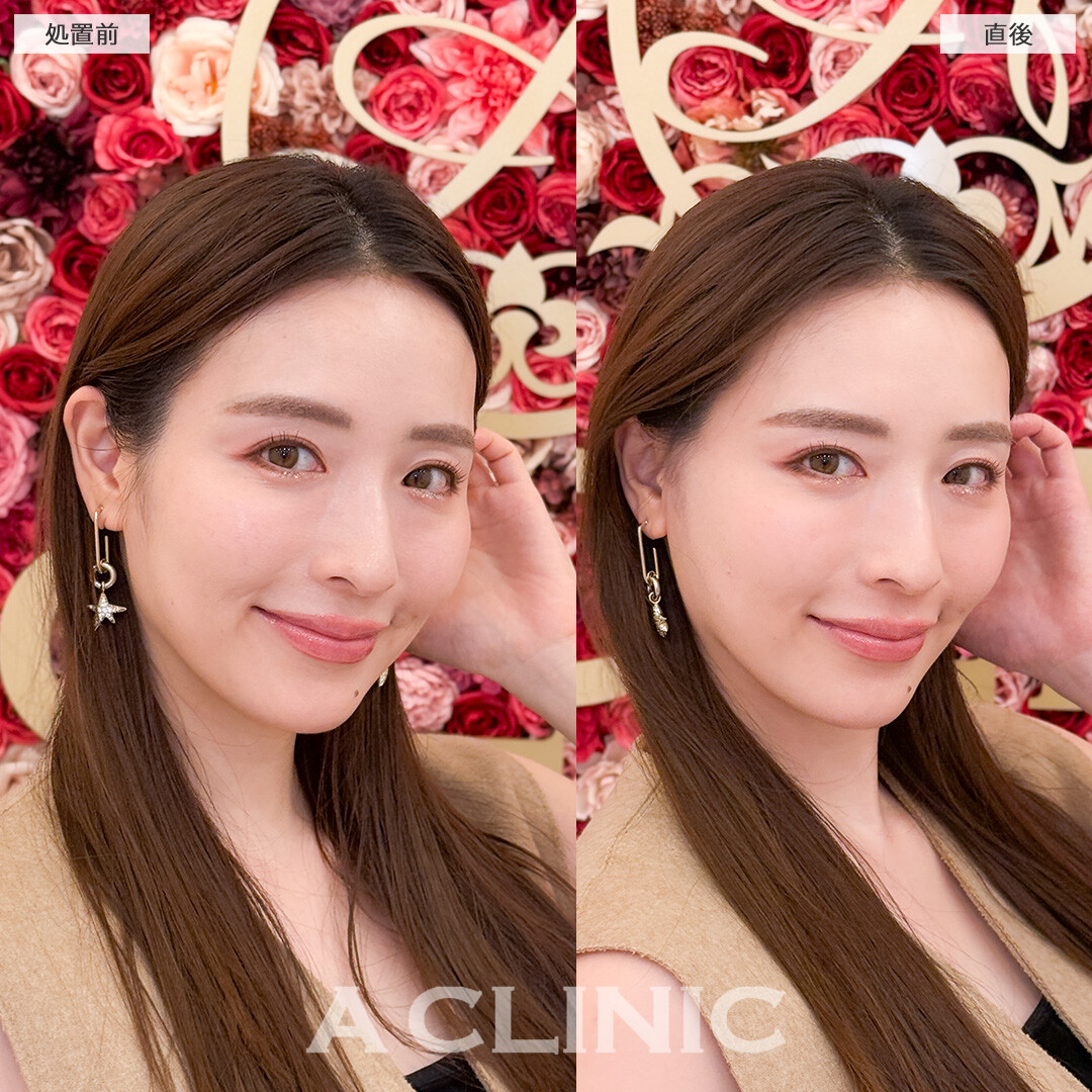 Aスレッドと頬へのヒアルロン酸注入で可愛い系から美人系に変身！処置前と直後の症例です(30代女性)