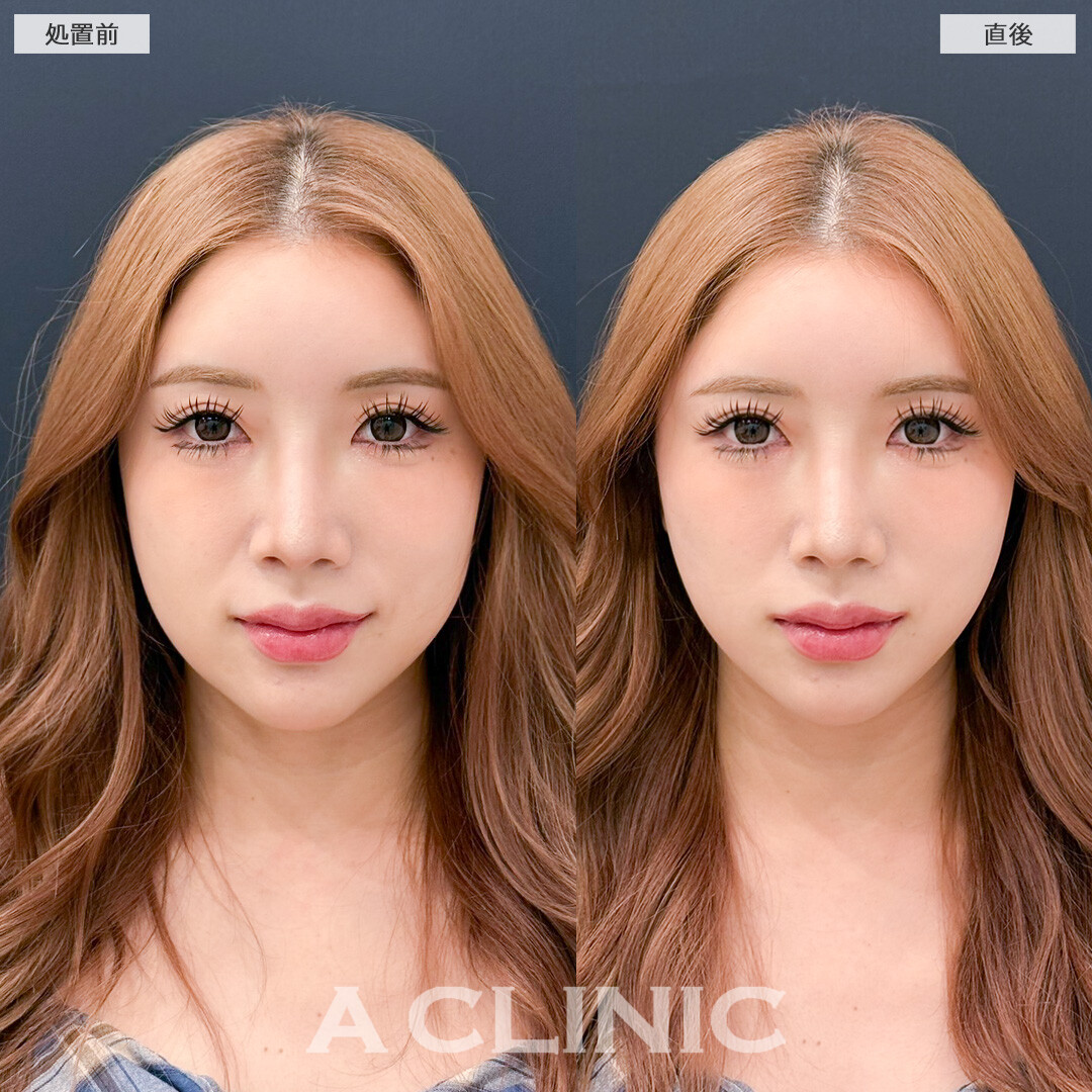 Aスレッドでフェイスラインのもたつきとほうれい線を同時に解決できました！処置前と直後の症例です(30代女性)