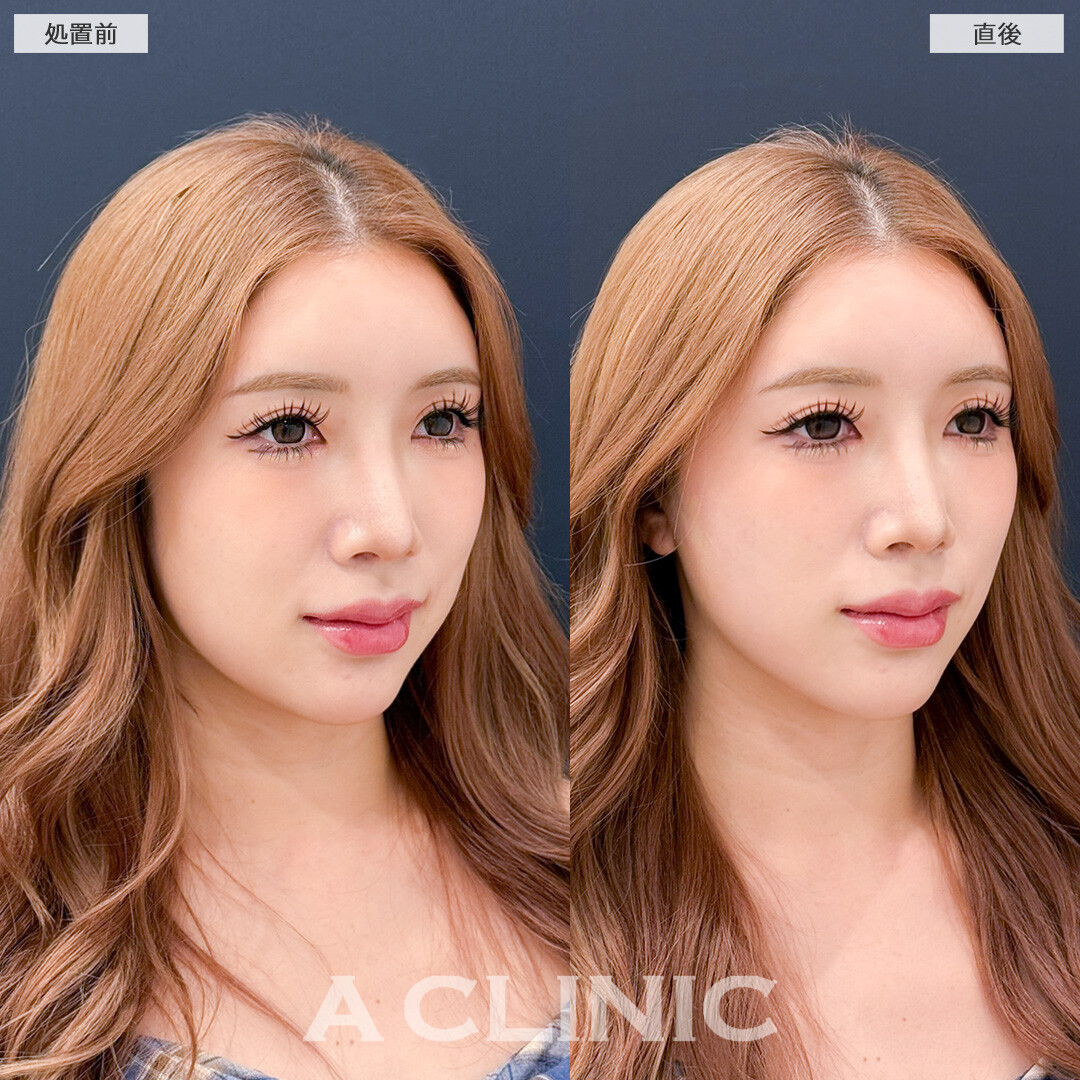 Aスレッドでフェイスラインのもたつきとほうれい線を同時に解決できました！処置前と直後の症例です(30代女性)