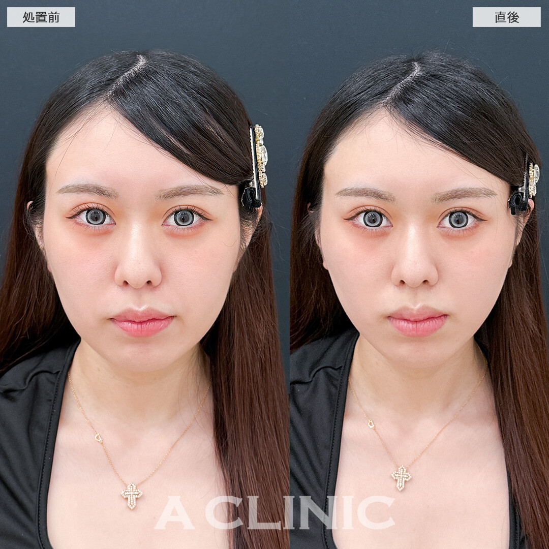 Aスレッドでもたつき引き上げて自分に似合う理想の輪郭にしてもらいました！処置前と直後の症例です(20代女性)