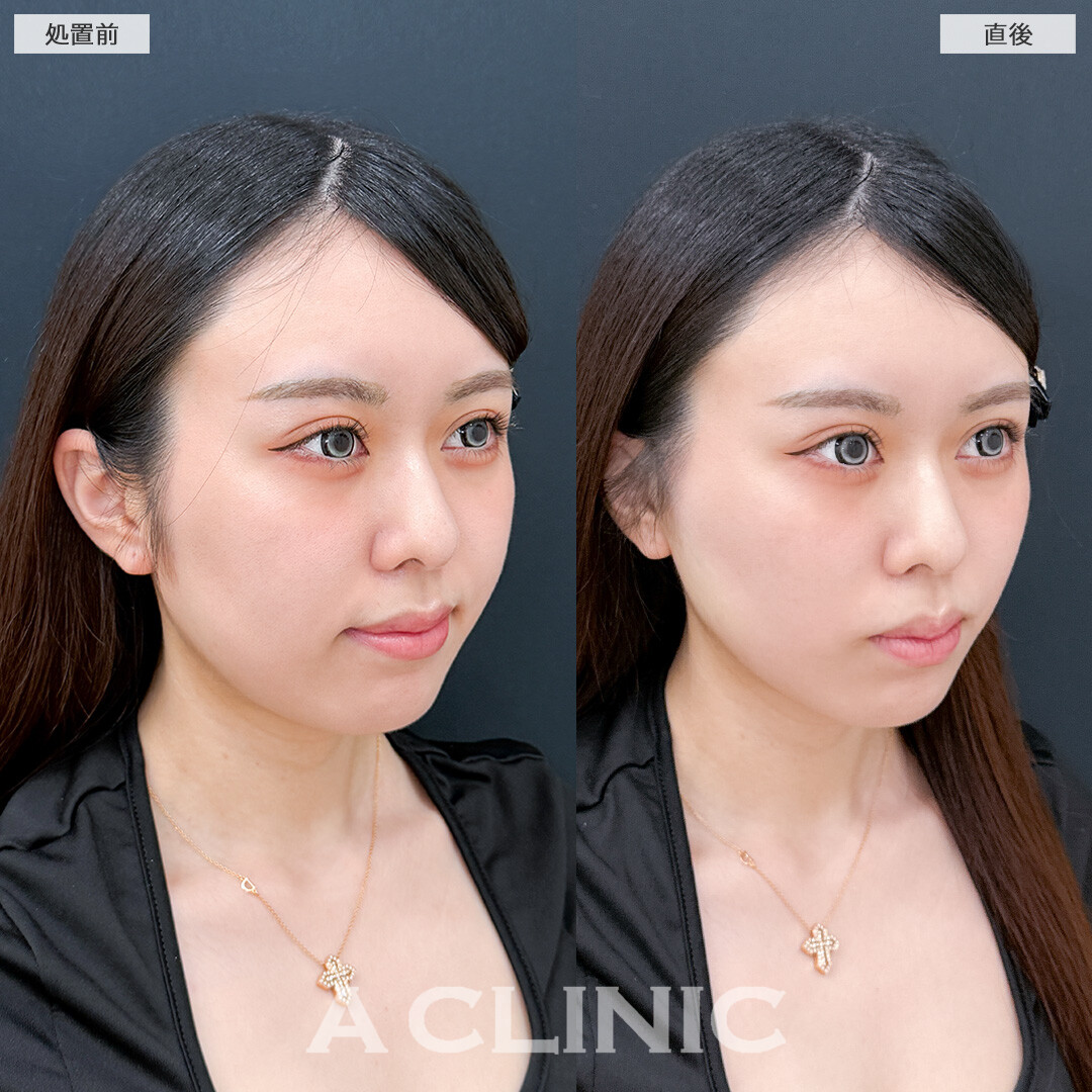 Aスレッドでもたつき引き上げて自分に似合う理想の輪郭にしてもらいました！処置前と直後の症例です(20代女性)
