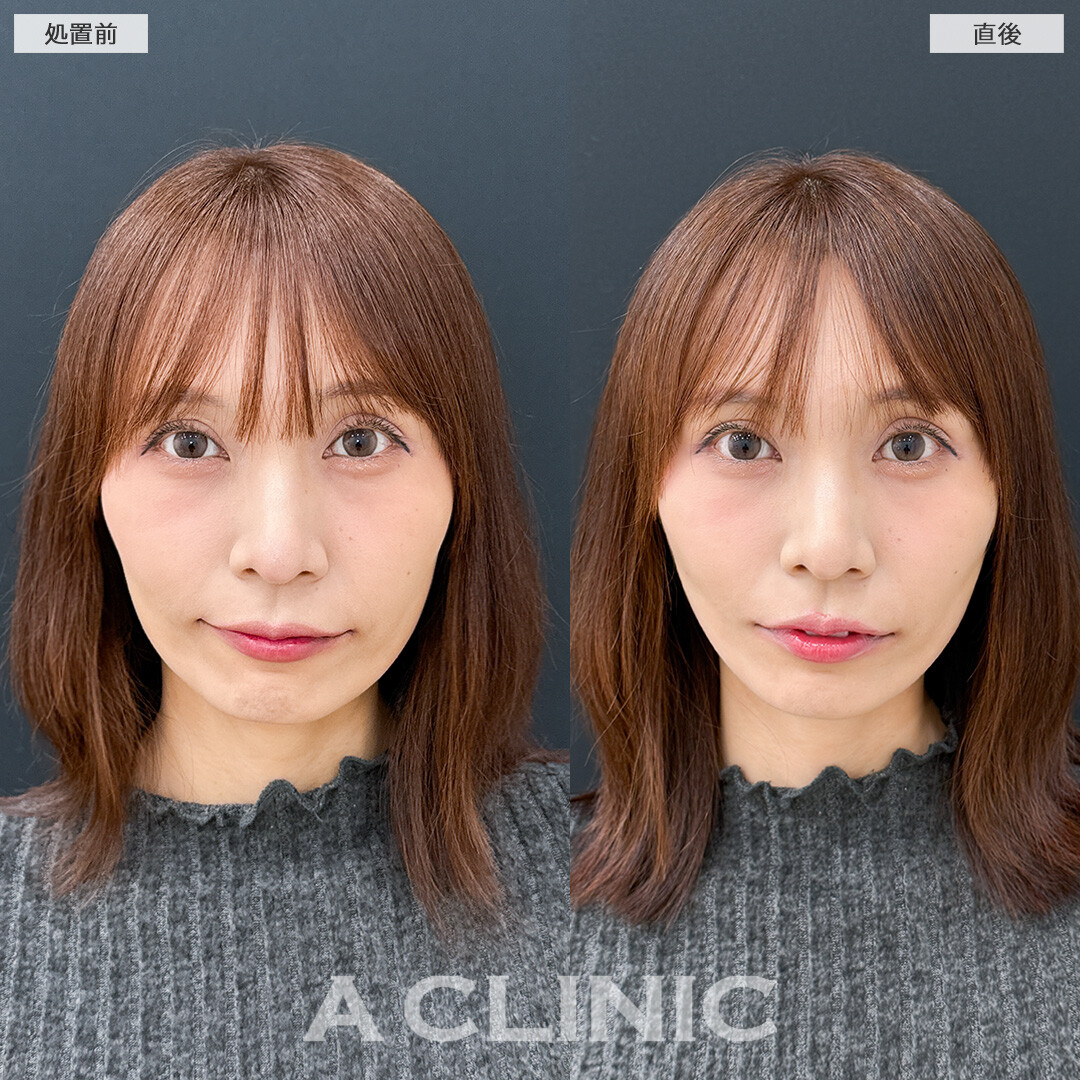 Aスレッドと頬へのヒアルロン酸注入でコケをなくしより女性らしいフェイスラインになりました！処置前と直後の症例です(30代女性)