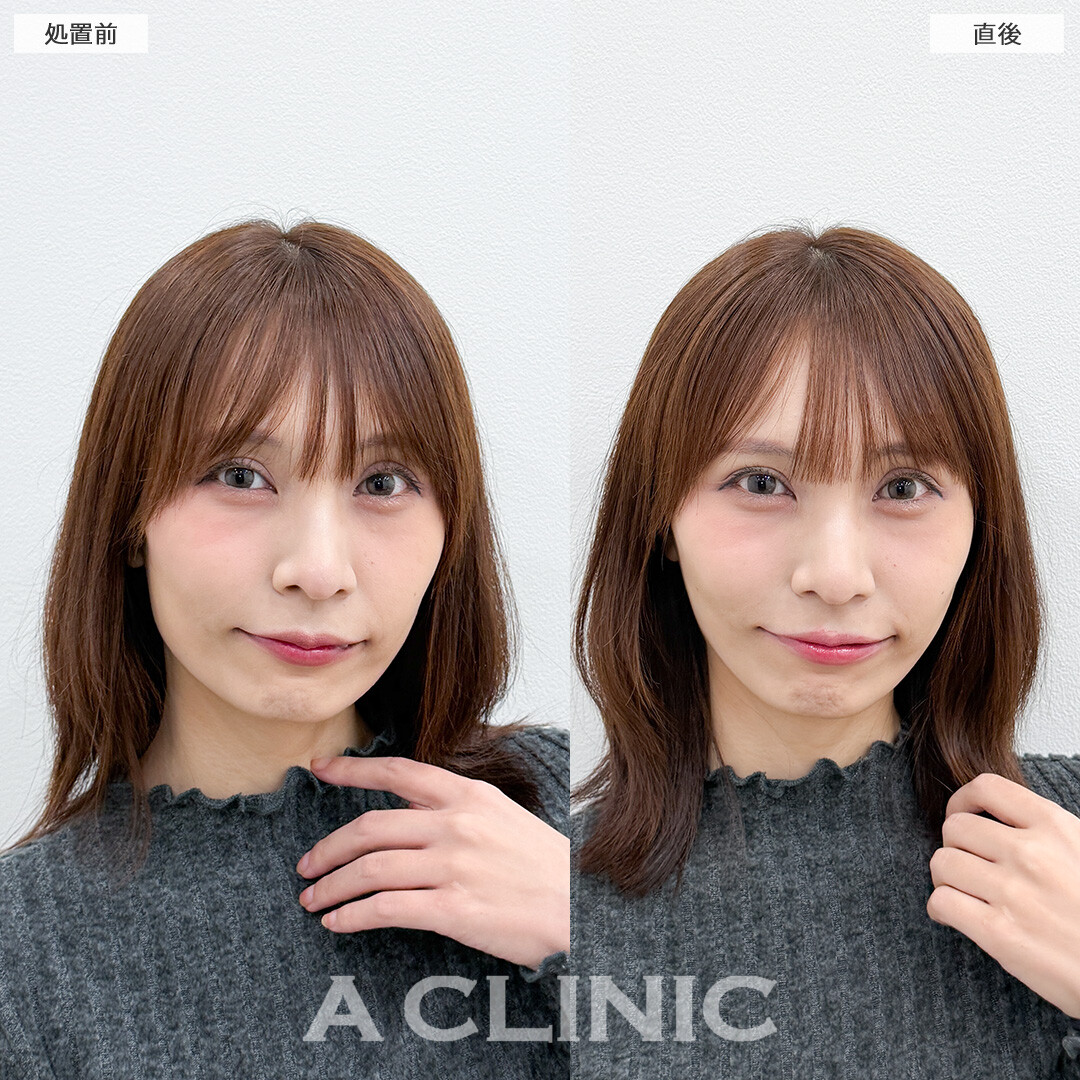 Aスレッドと頬へのヒアルロン酸注入でコケをなくしより女性らしいフェイスラインになりました！処置前と直後の症例です(30代女性)