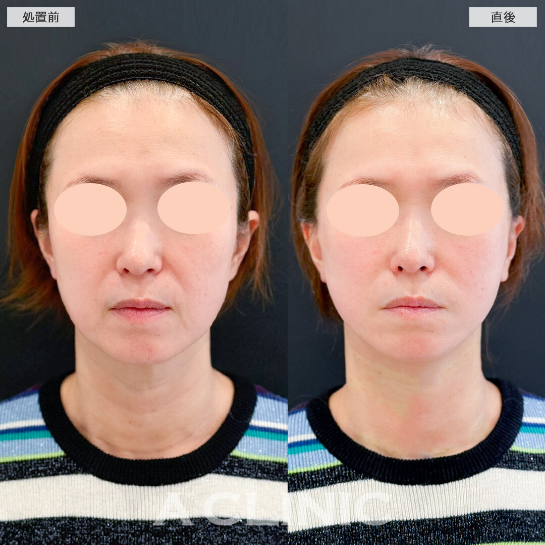 Aスレッドでほうれい線も口横のたるみもスッキリ解消！処置前と直後の症例です(50代女性)