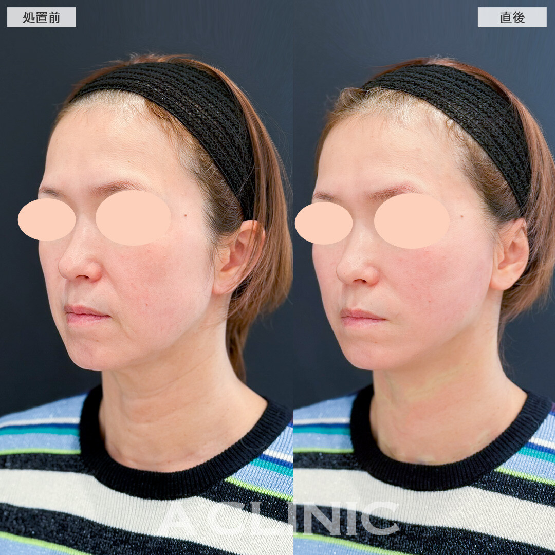 Aスレッドでほうれい線も口横のたるみもスッキリ解消！処置前と直後の症例です(50代女性)