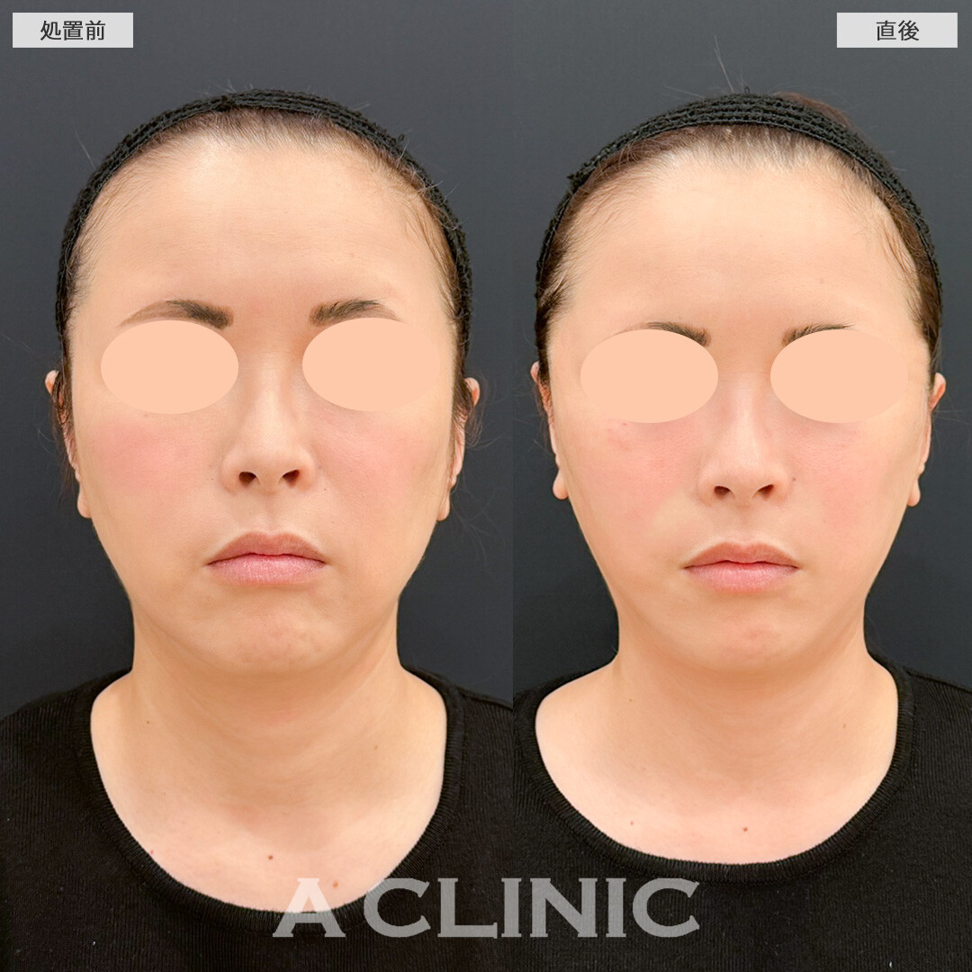 Aスレッドで顔全体をキュッと引き締め若返り効果実感！処置前と直後の症例です(40代女性)