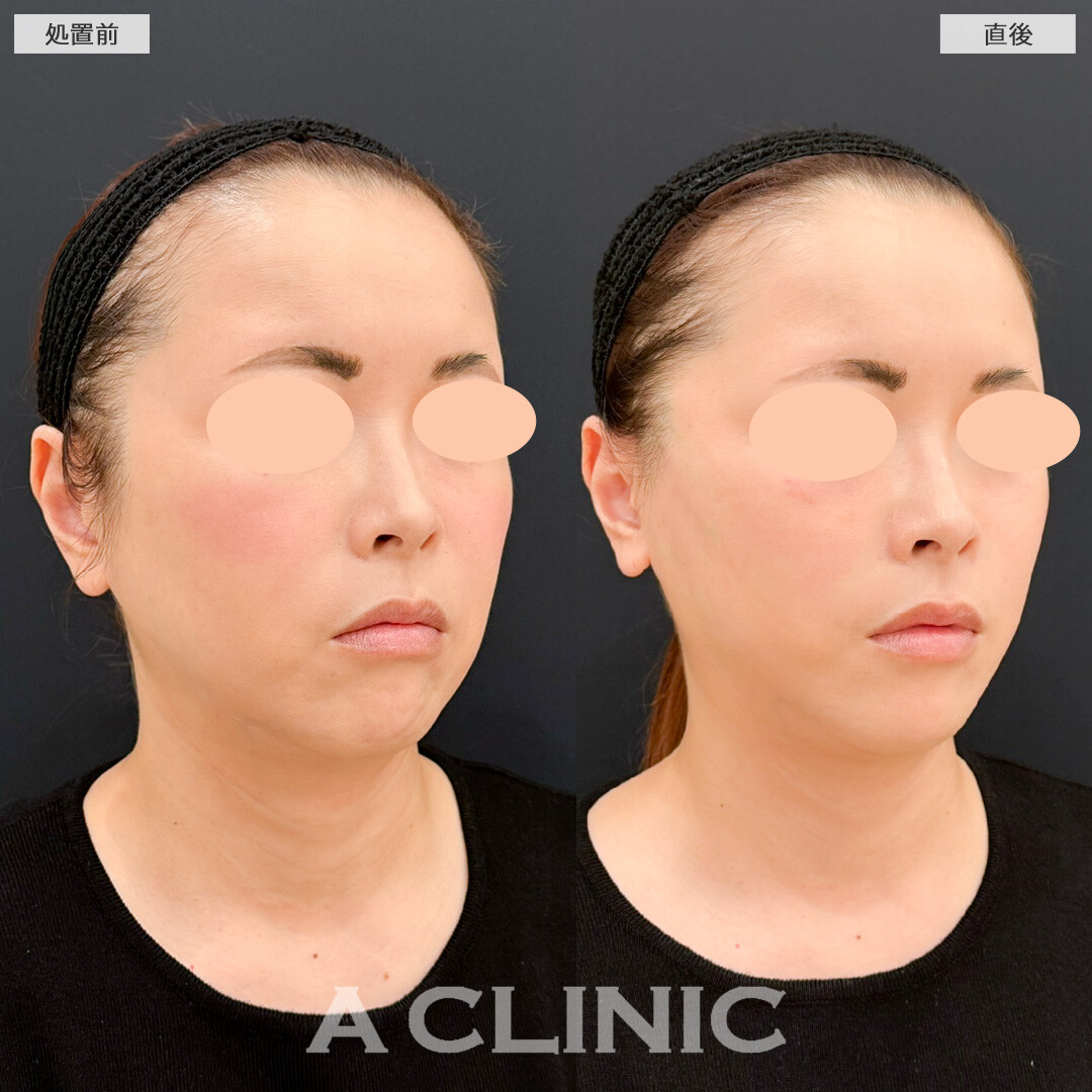 Aスレッドで顔全体をキュッと引き締め若返り効果実感！処置前と直後の症例です(40代女性)