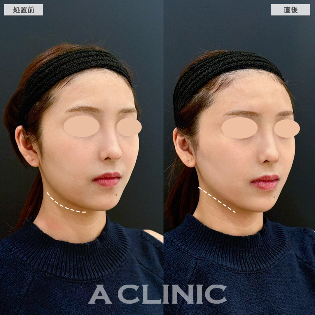 Aスレッドでさらに輪郭を綺麗に整える！こちら処置前と直後の症例です(20代女性)