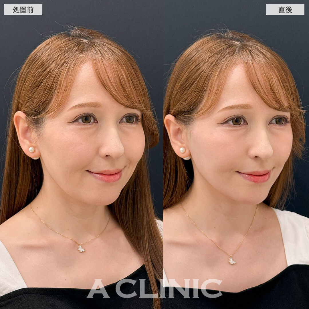 Aスレッドでお悩みだったほうれい線改善しました！こちら処置前と直後の症例です(40代女性)
