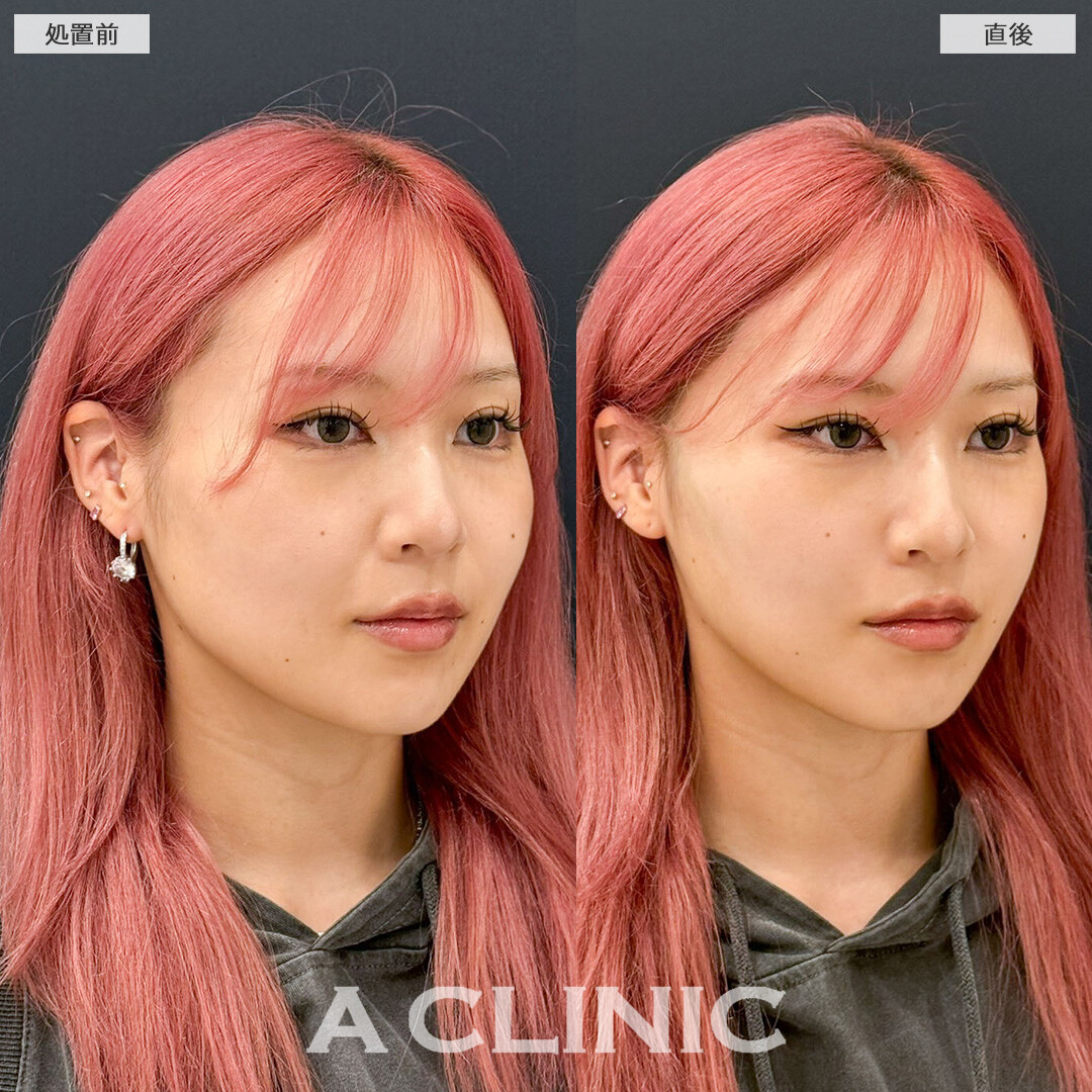 Aスレッドで気になっていたほうれい線も薄くなりました！こちら処置前と直後の症例です(20代女性)