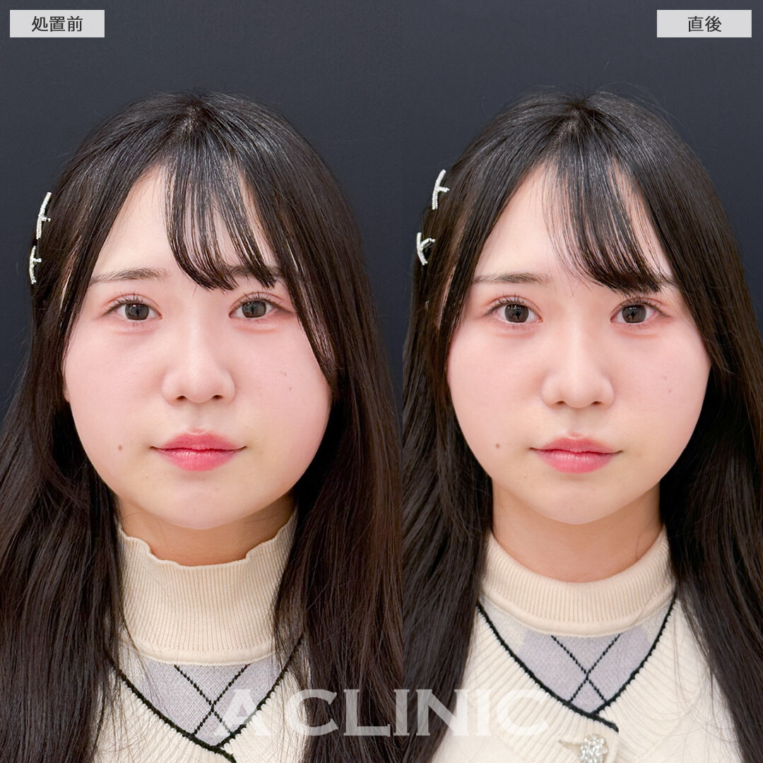 Aスレッドで余白を縮小しお顔の印象が変わりました！処置前と直後の症例です(30代女性)