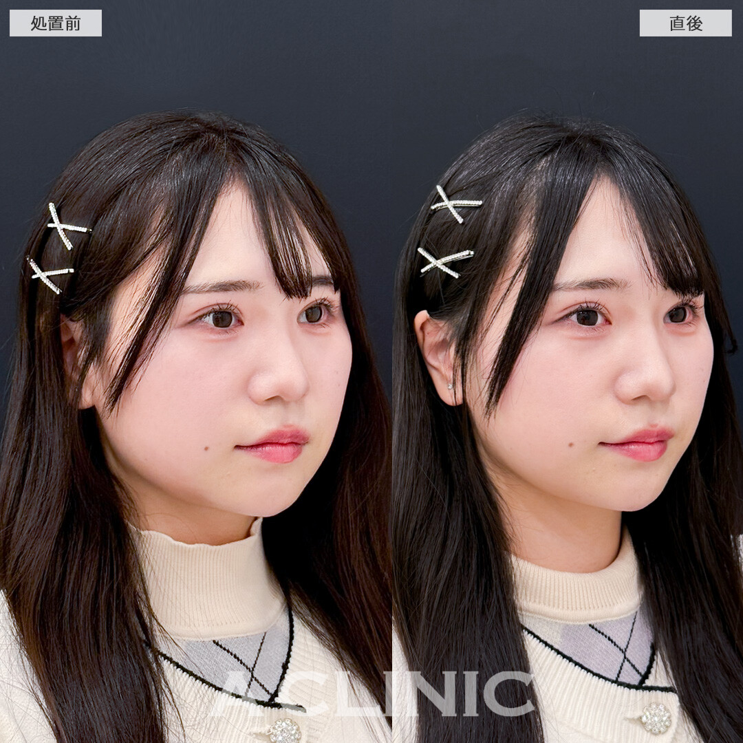 Aスレッドで余白を縮小しお顔の印象が変わりました！処置前と直後の症例です(30代女性)