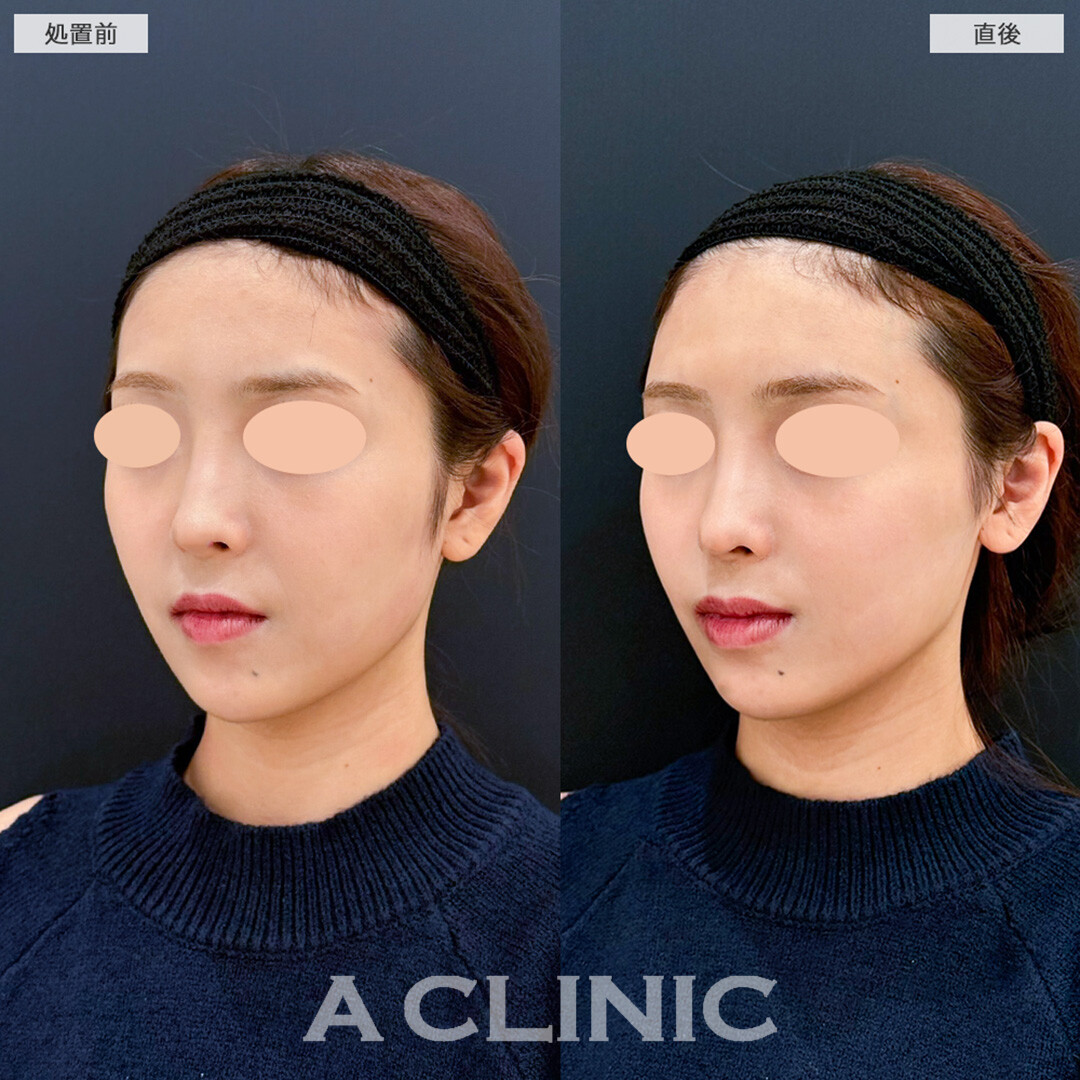 Aスレッドでさらに輪郭を綺麗に整える！こちら処置前と直後の症例です(20代女性)
