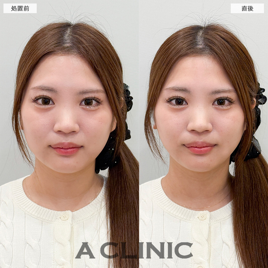 Aスレッドで即日リフトアップが叶う！処置前と直後の症例です(20代女性)